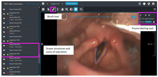 Sensors | Free Full-Text | AI-Based Detection of Aspiration for Video- Endoscopy with Visual Aids in Meaningful Frames to Interpret the Model  Outcome