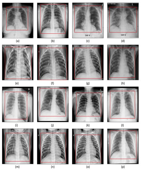 Sensors | Free Full-Text | Detection of COVID-19 in X-ray Images