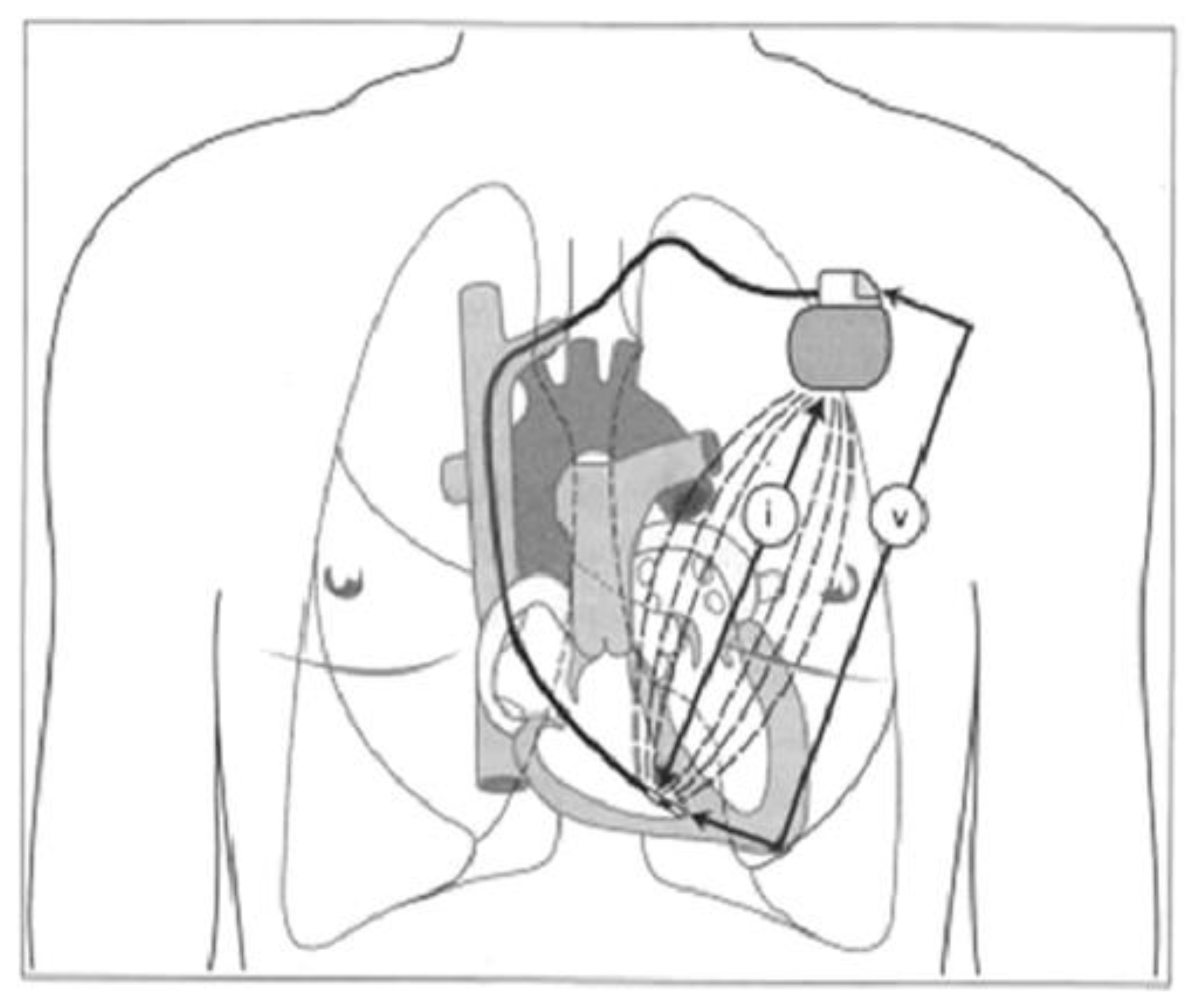 Sensors | Free Full-Text | Rate-Responsive Cardiac Pacing: Technological  Solutions and Their Applications