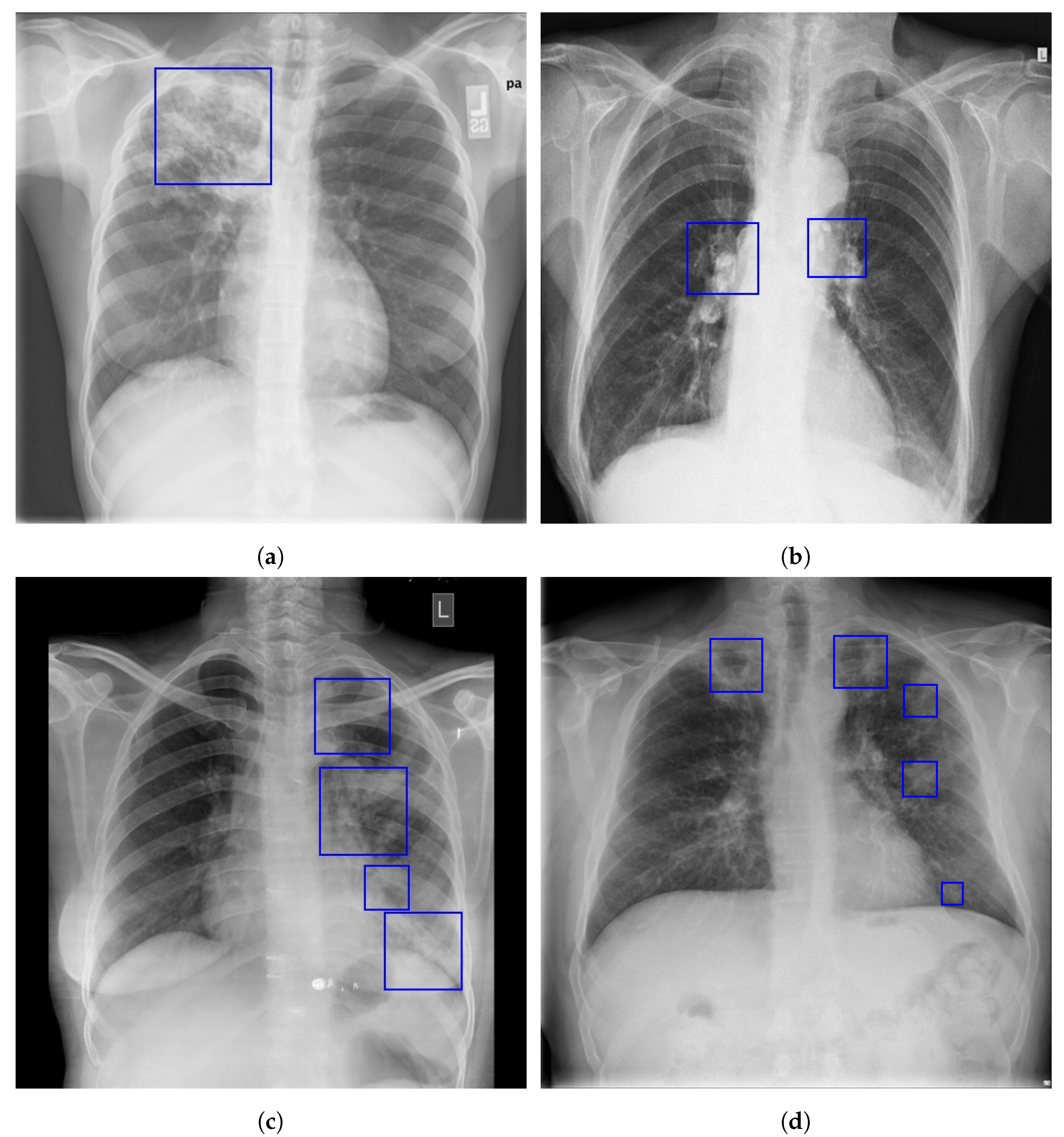 chest x ray tb vs normal