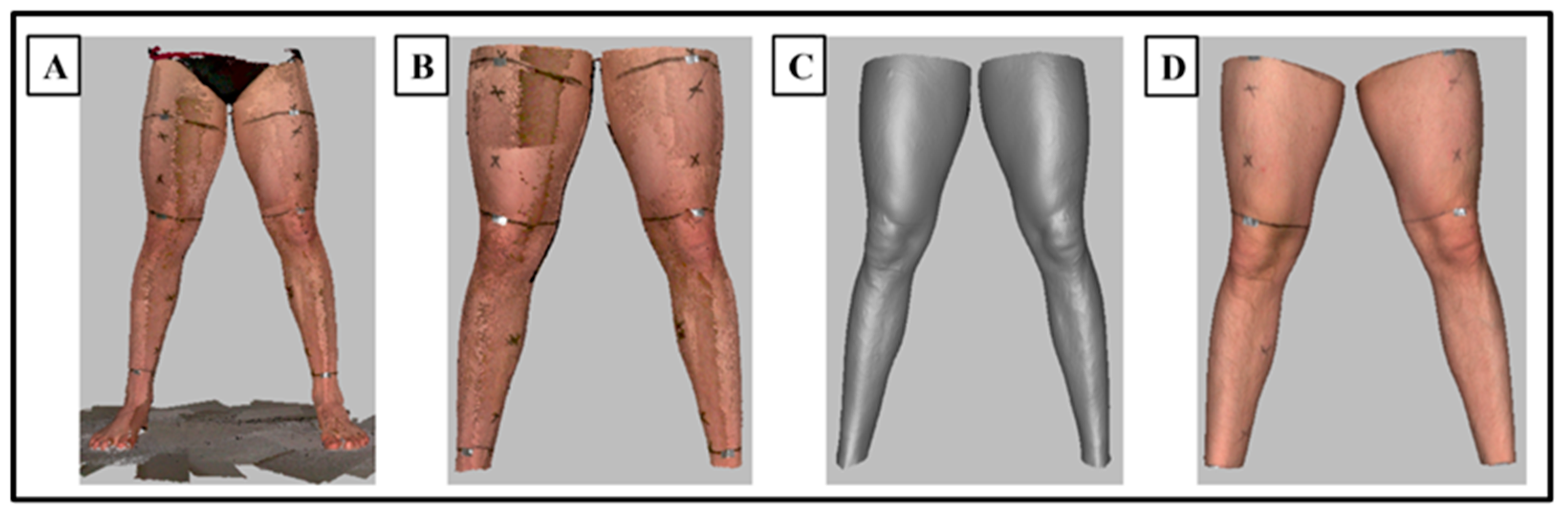 Digital Leg Volume Quantification: Precision Assessment of a Novel Workflow  Based on Single Capture Three-dimensional Whole-Body Surface Imaging