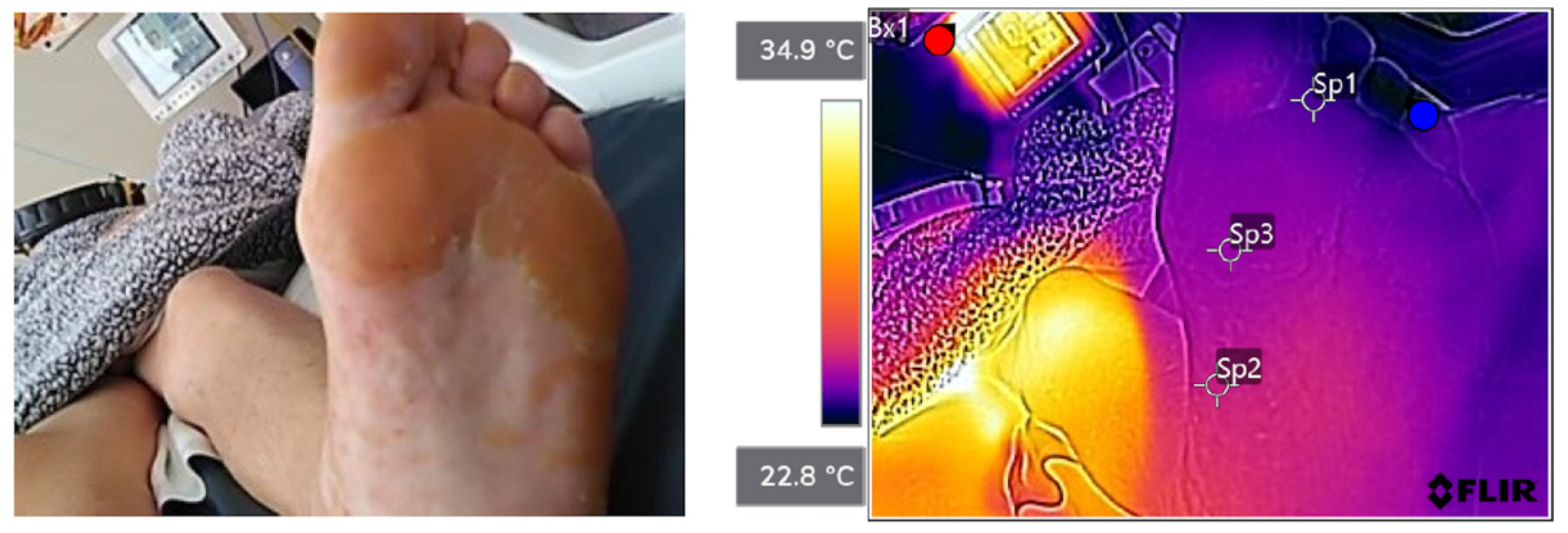 Sensors | Free Full-Text | Utility of Thermographic Imaging for Callus  Identification in Wound and Foot Care