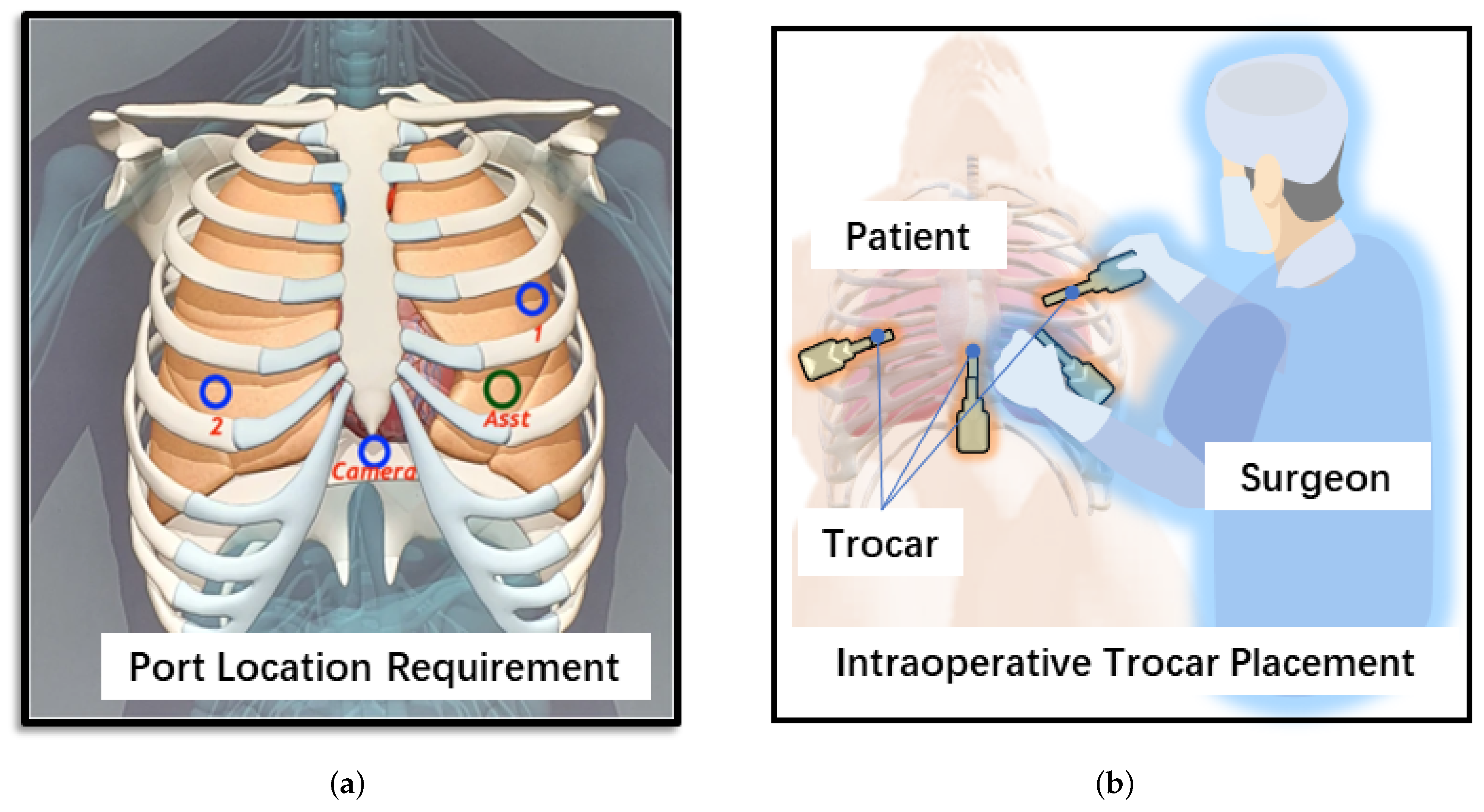 Port placement, trocar sizes and intraoperative setting. The ports in