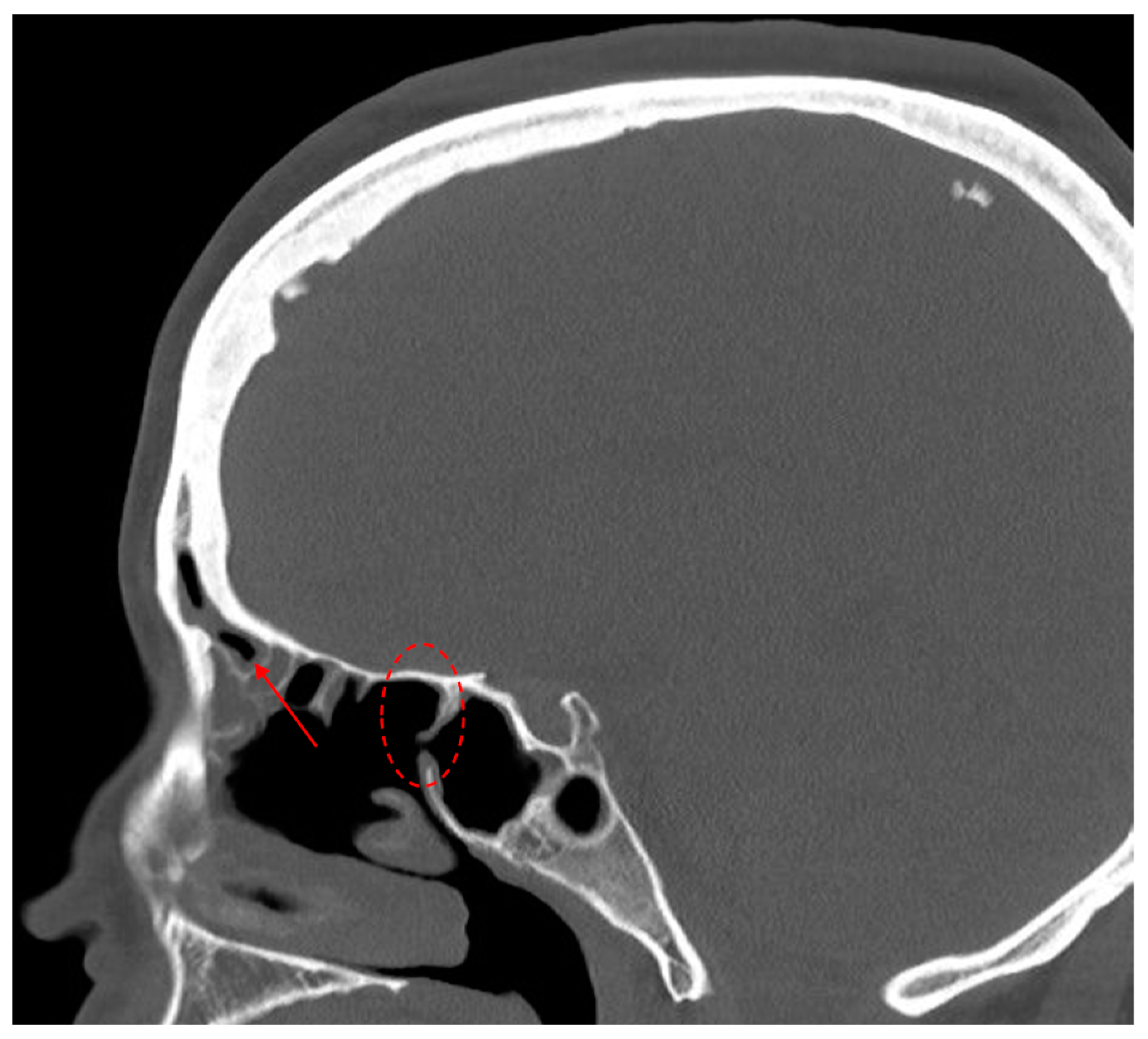 Sinusitis 08 00005 g004 Sinusitis 08 00005 g004