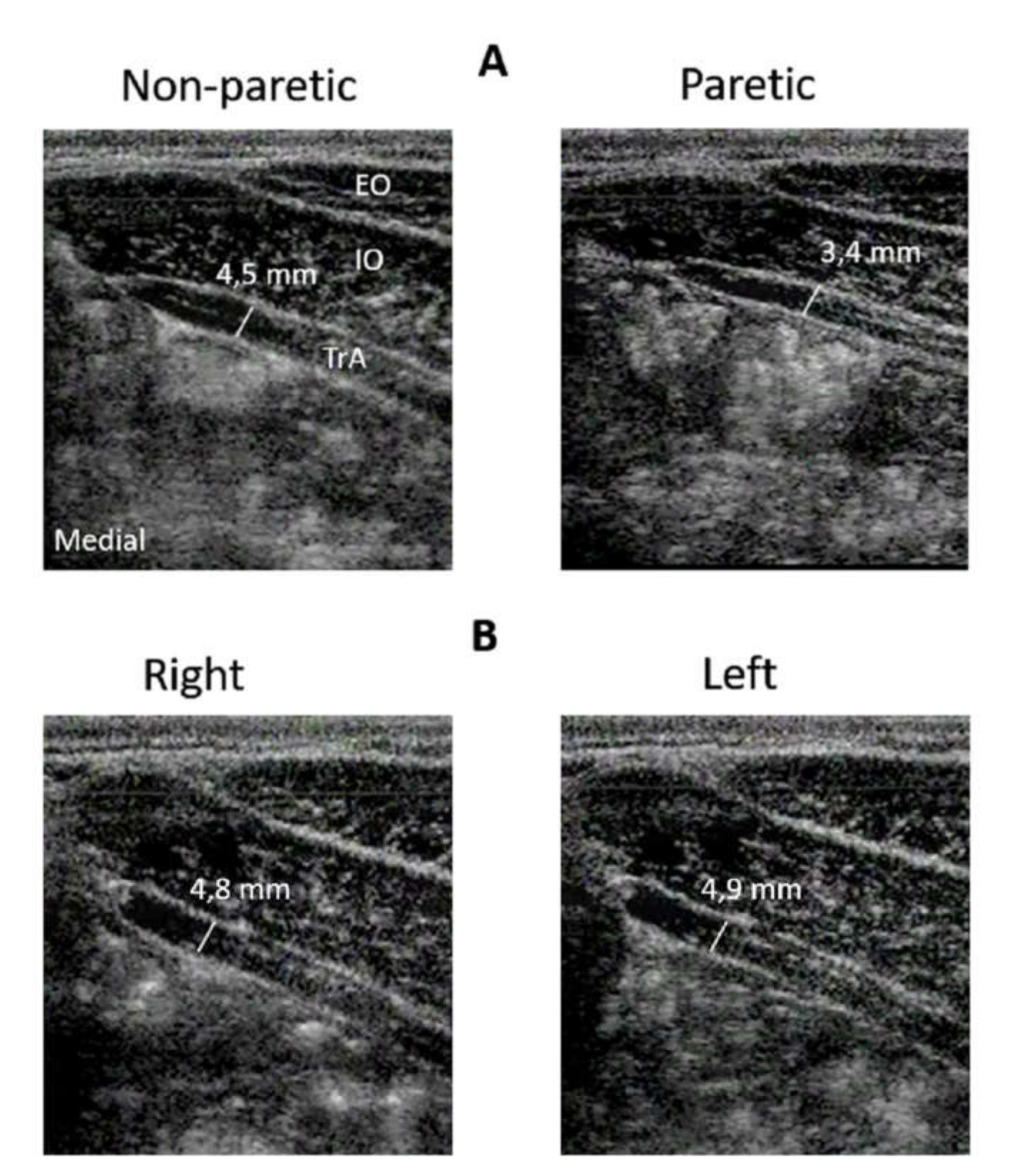 Activity of deep abdominal muscles increases during submaximal