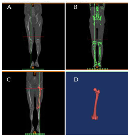 x ray femoral anteversion