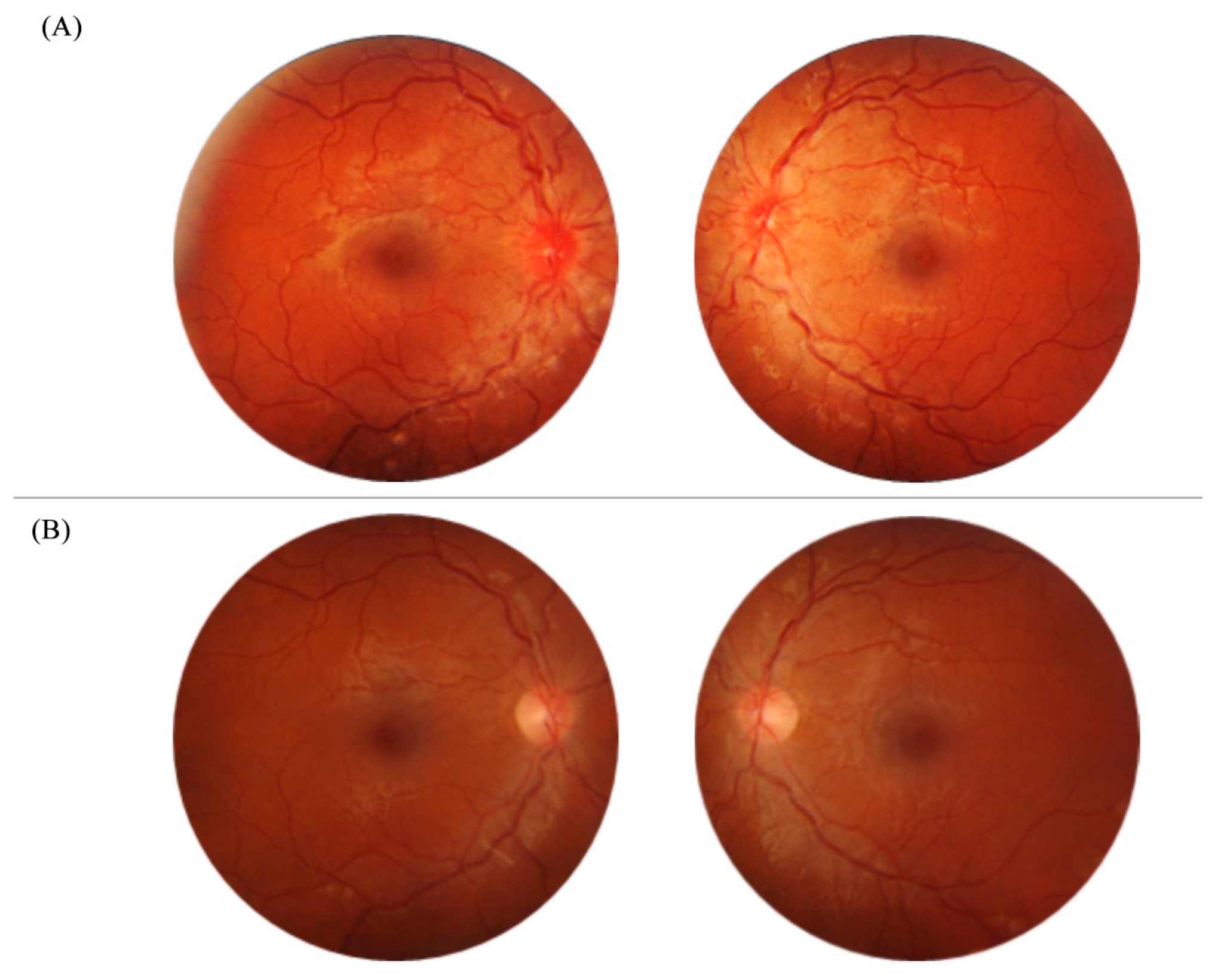 An 18-year-old man with dominant optic atrophy (DOA). The fundus