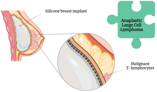 Woman breast implant cross section. Comparison diagram, under and