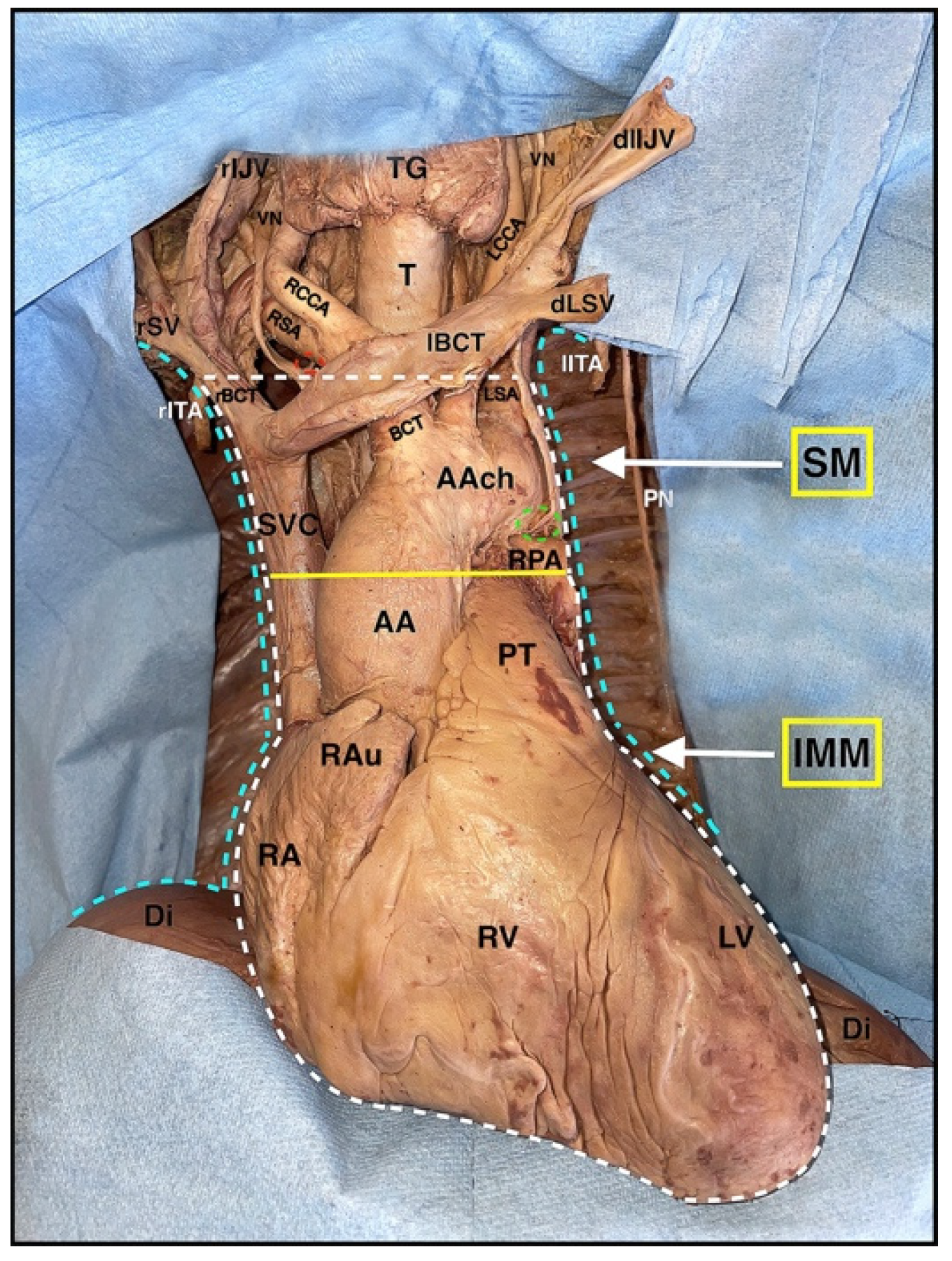 posterior mediastinum dissection