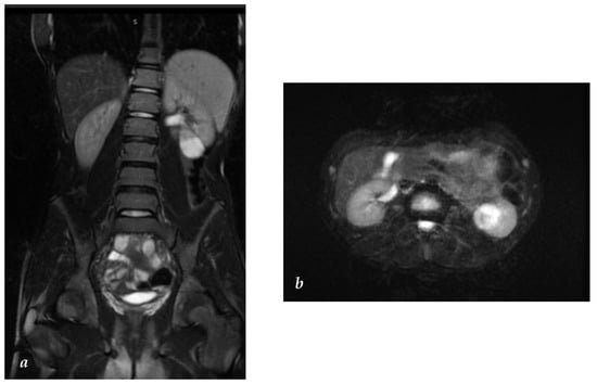 Surgeries | Free Full-Text | A Bosniak III Cyst Unmasking Tubulocystic ...