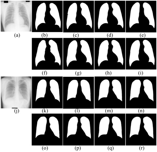 Symmetry Free Full Text Automatic Lung Segmentation Algorithm On Chest X Ray Images Based On Fusion Variational Auto Encoder And Three Terminal Attention Mechanism Html