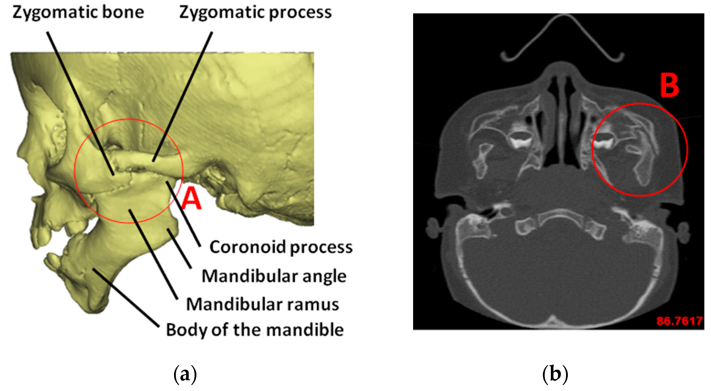 condylar process of mandible