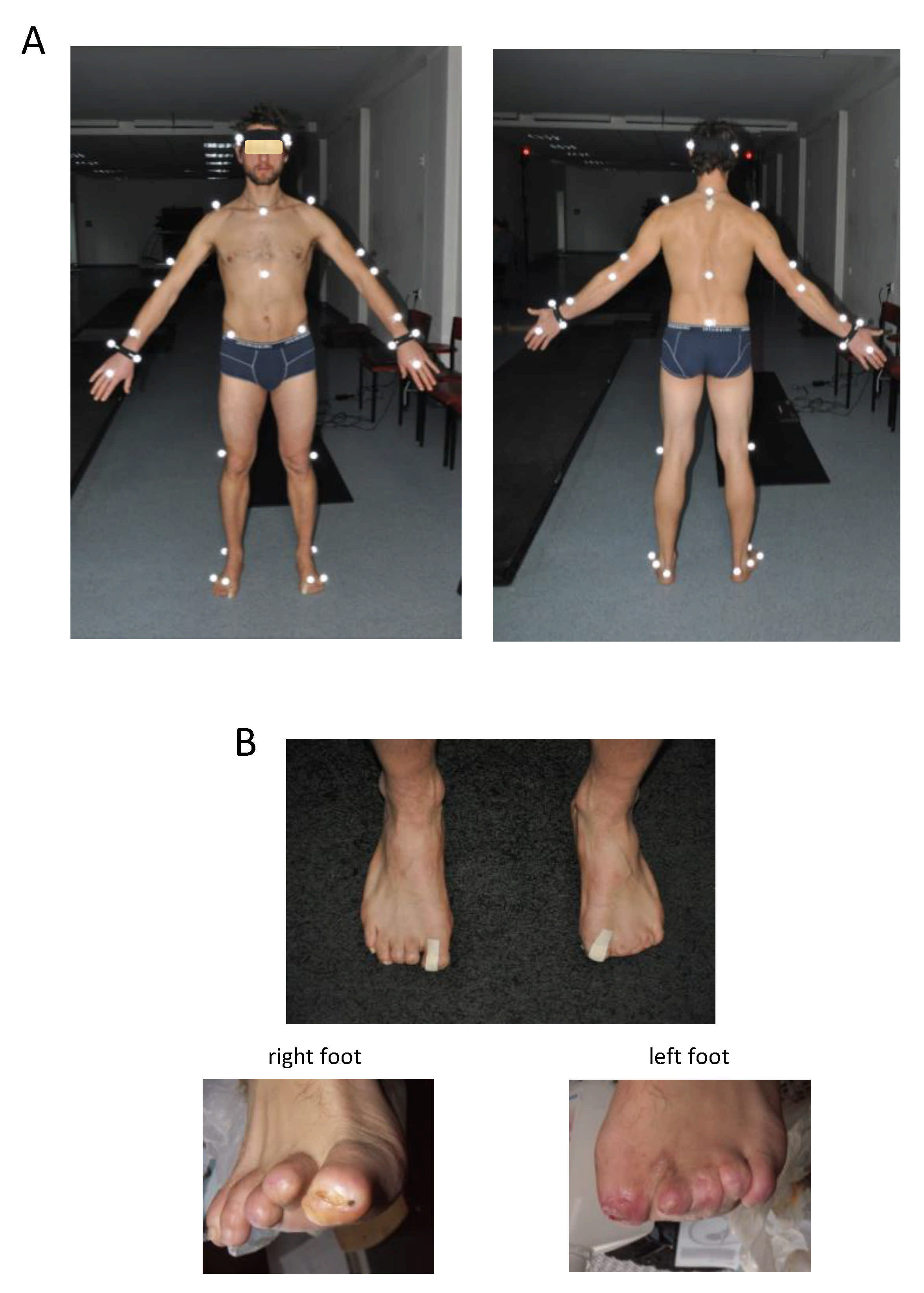 Symmetry | Free Full-Text | Adjustments in the Range of Angular Motion  during Walking after Amputation of the Toes: A Case Report