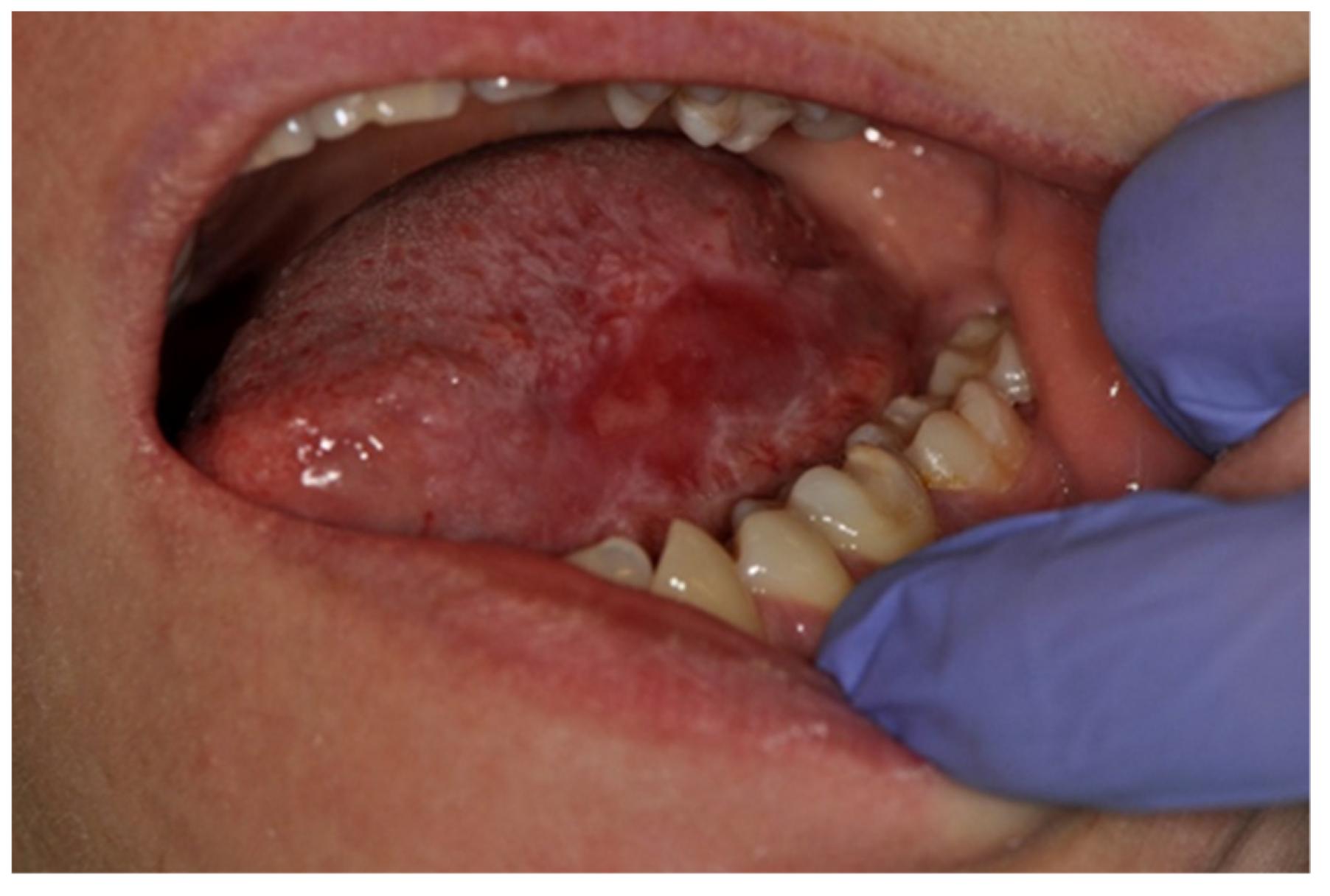 Lichen Planus On Side Of Tongue Hot Sex Picture