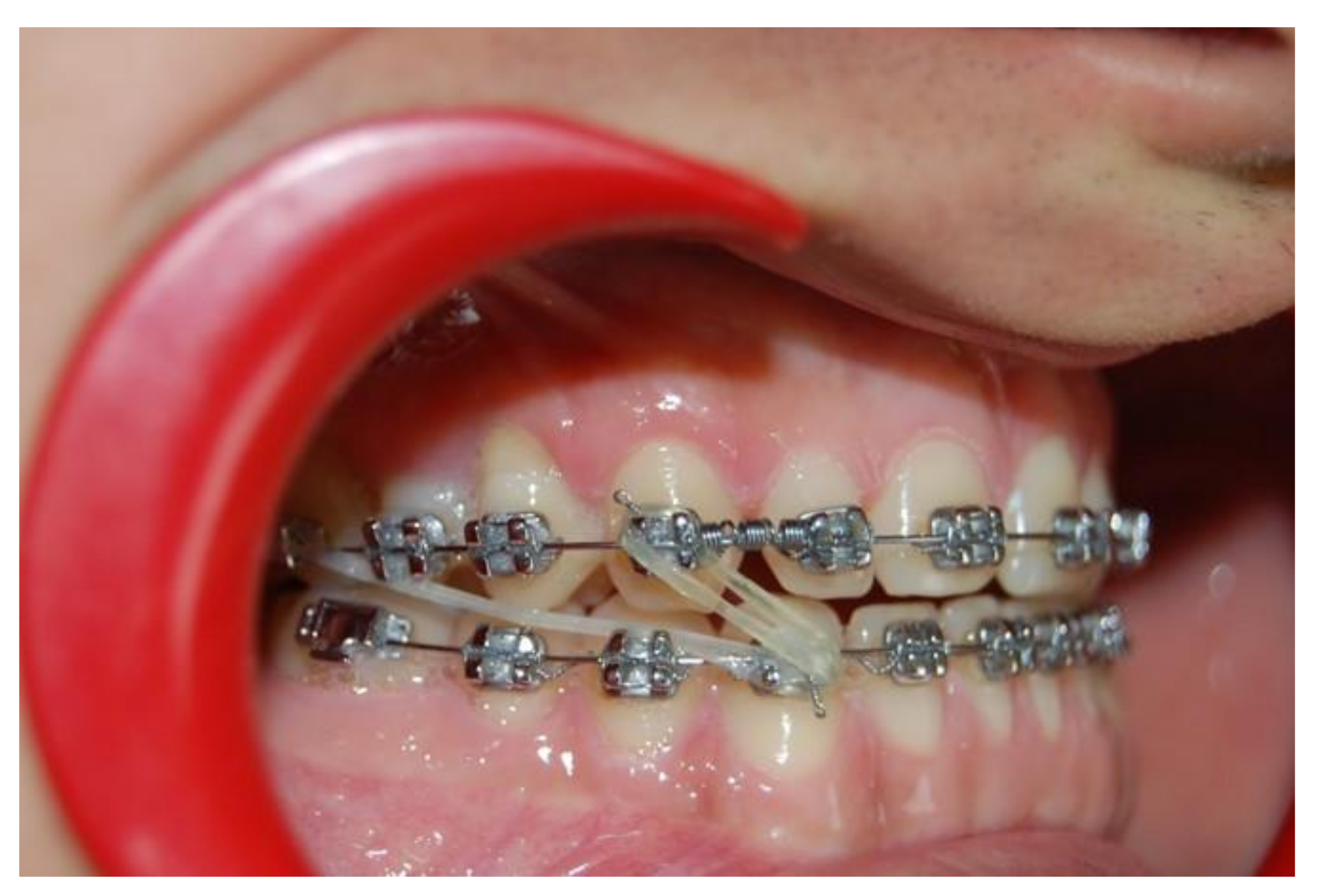 Braces – Non-extraction Straightwire Technique - Non-Extraction