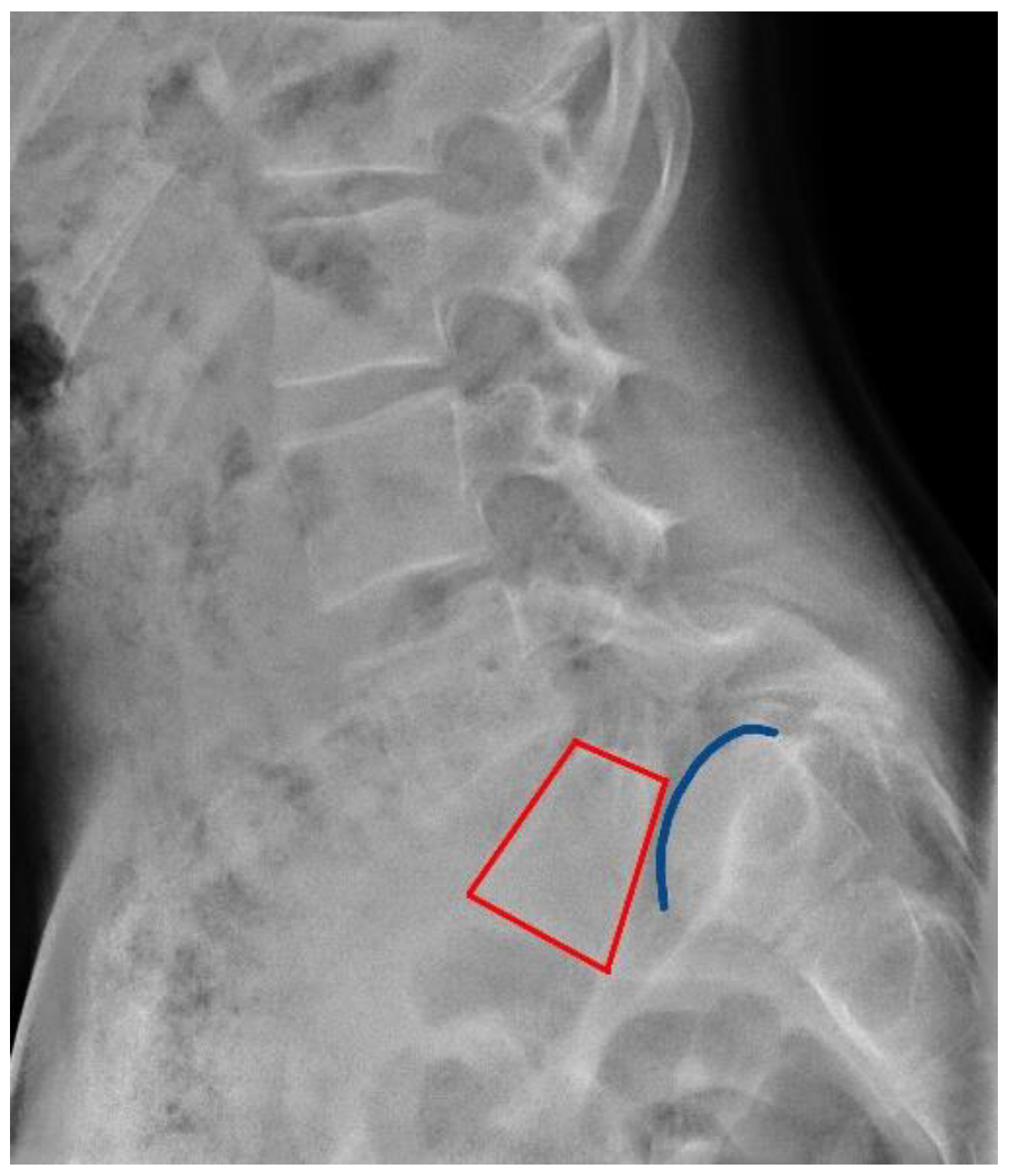 ferguson view of lumbar spine