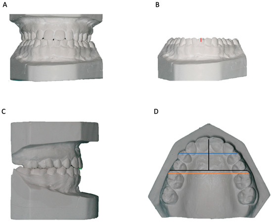 Symmetry | Free Full-Text | Relapse after Orthodontic-Surgical ...