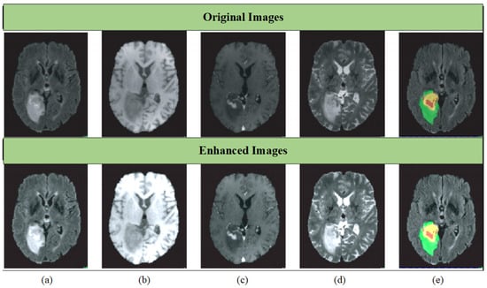 Edge U-Net: Brain tumor segmentation using MRI based on deep U-Net