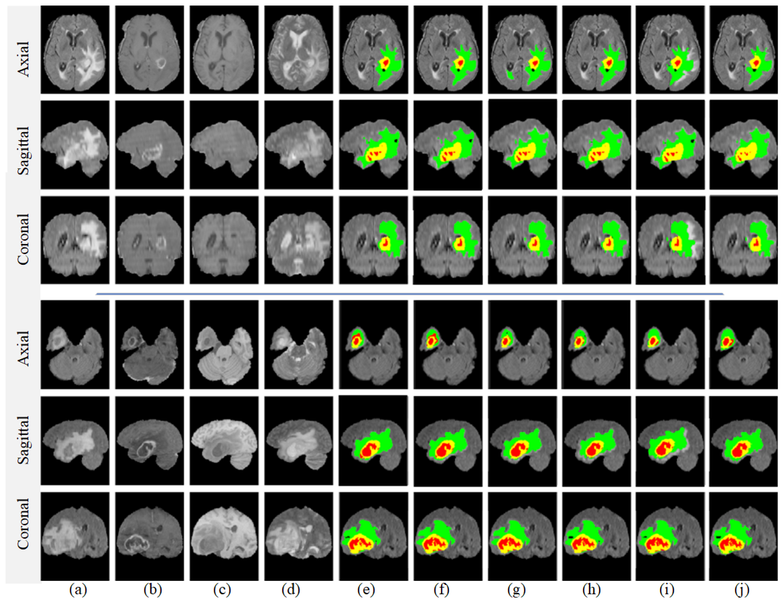 Edge U-Net: Brain tumor segmentation using MRI based on deep U-Net