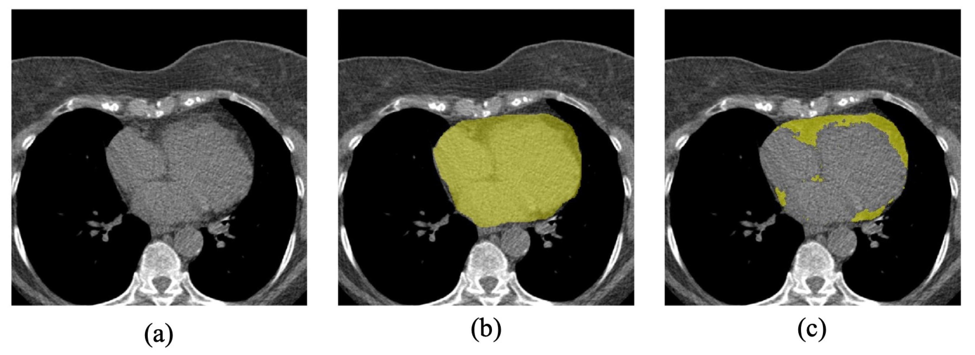 Solved Label these structures of the breast. Adipose tissue