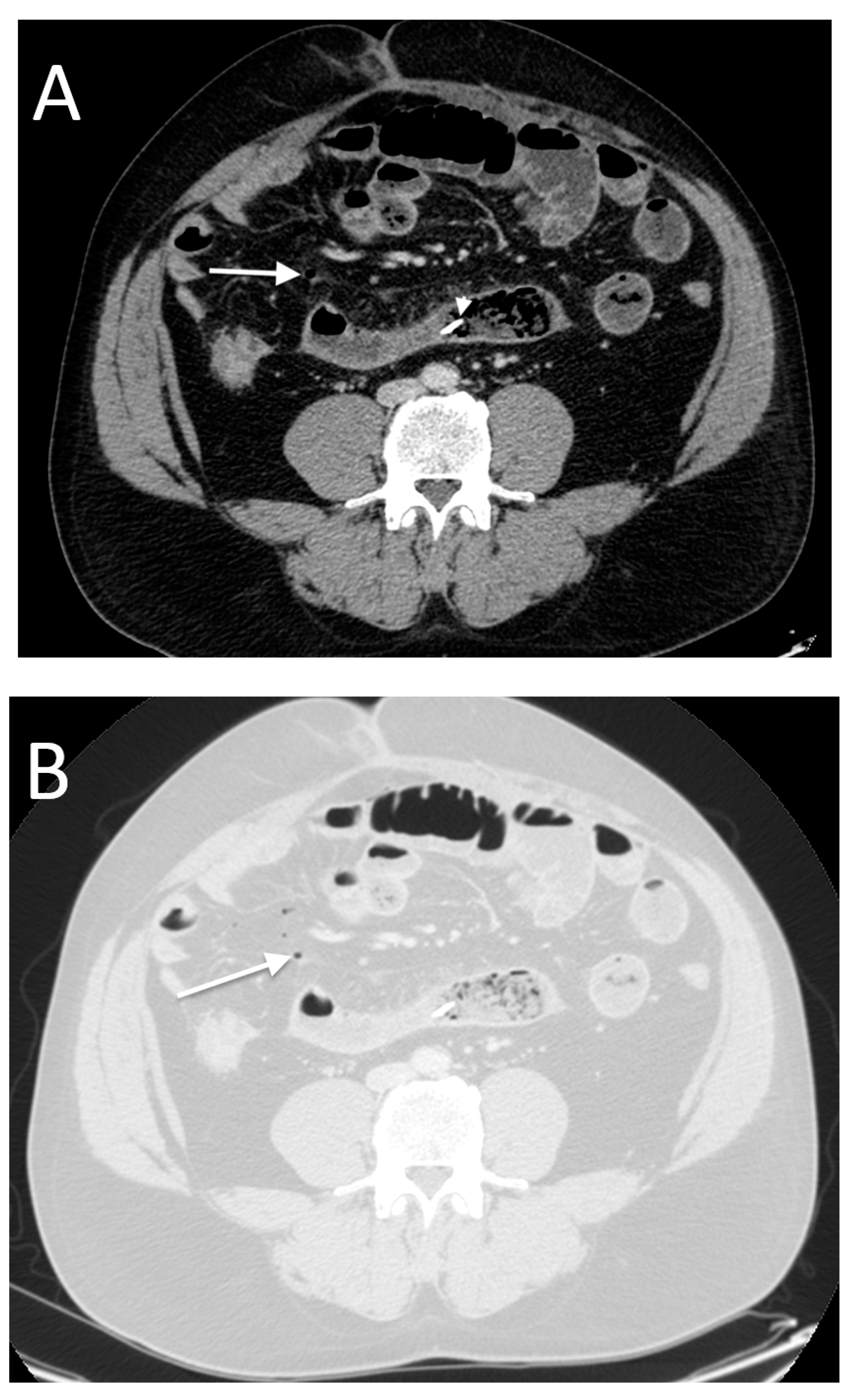 Tomography | Free Full-Text | MDCT Findings In Gastrointestinal ...