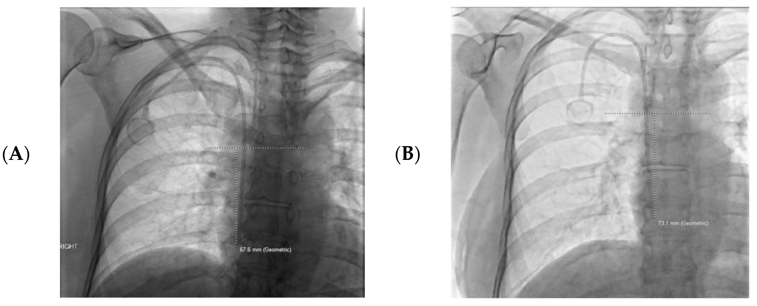 Tomography | Free Full-Text | Internal Jugular Central Venous Catheter Tip  Migration: Patient and Procedural Factors