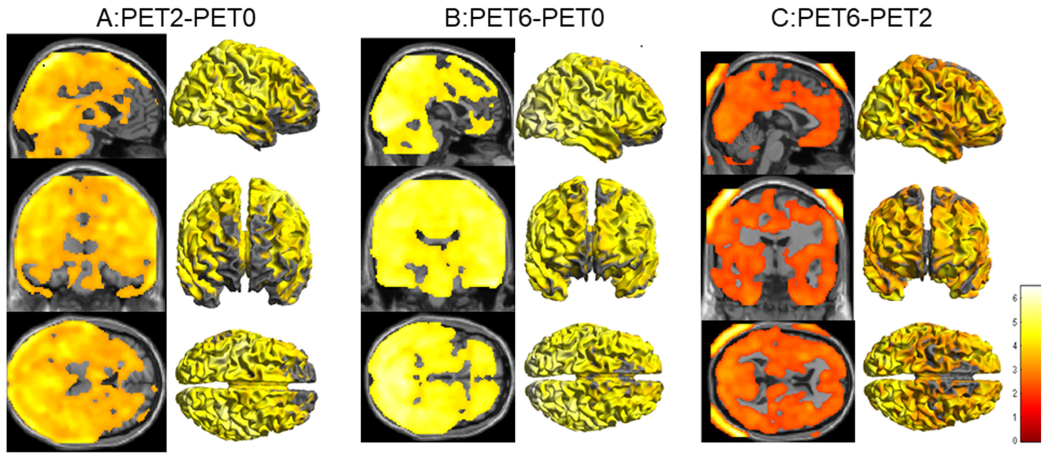 Tomography | Free Full-Text | Evaluation of the Effects of R-CHOP  Chemotherapy on Brain Glucose Metabolism in Patients with Diffuse Large B  Cell Lymphoma: A Baseline, Interim, and End-of-Treatment PET/CT Study