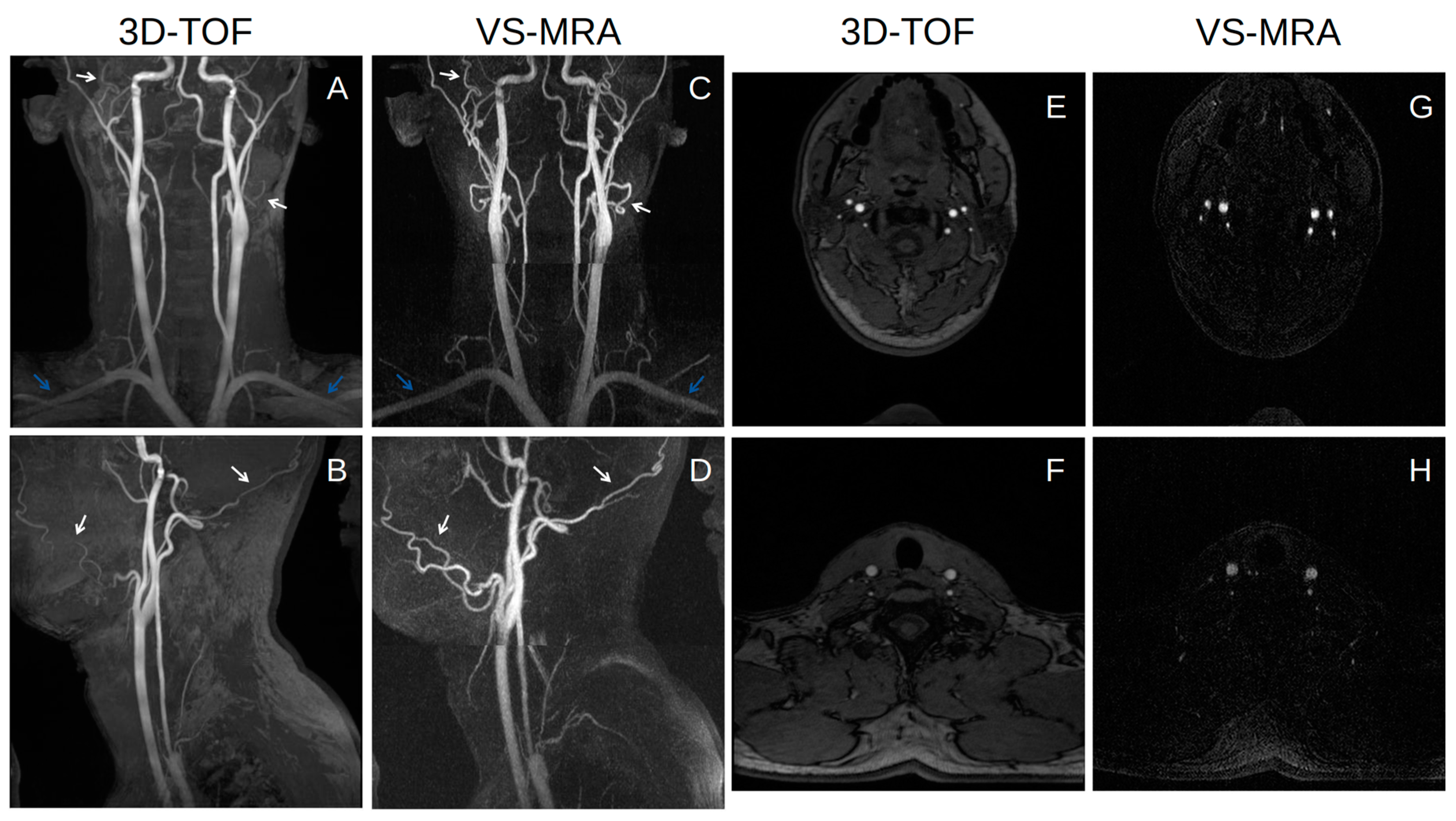 Tomography | Free Full-Text | Whole-Neck Non-Contrast-Enhanced MR  Angiography Using Velocity Selective Magnetization Preparation