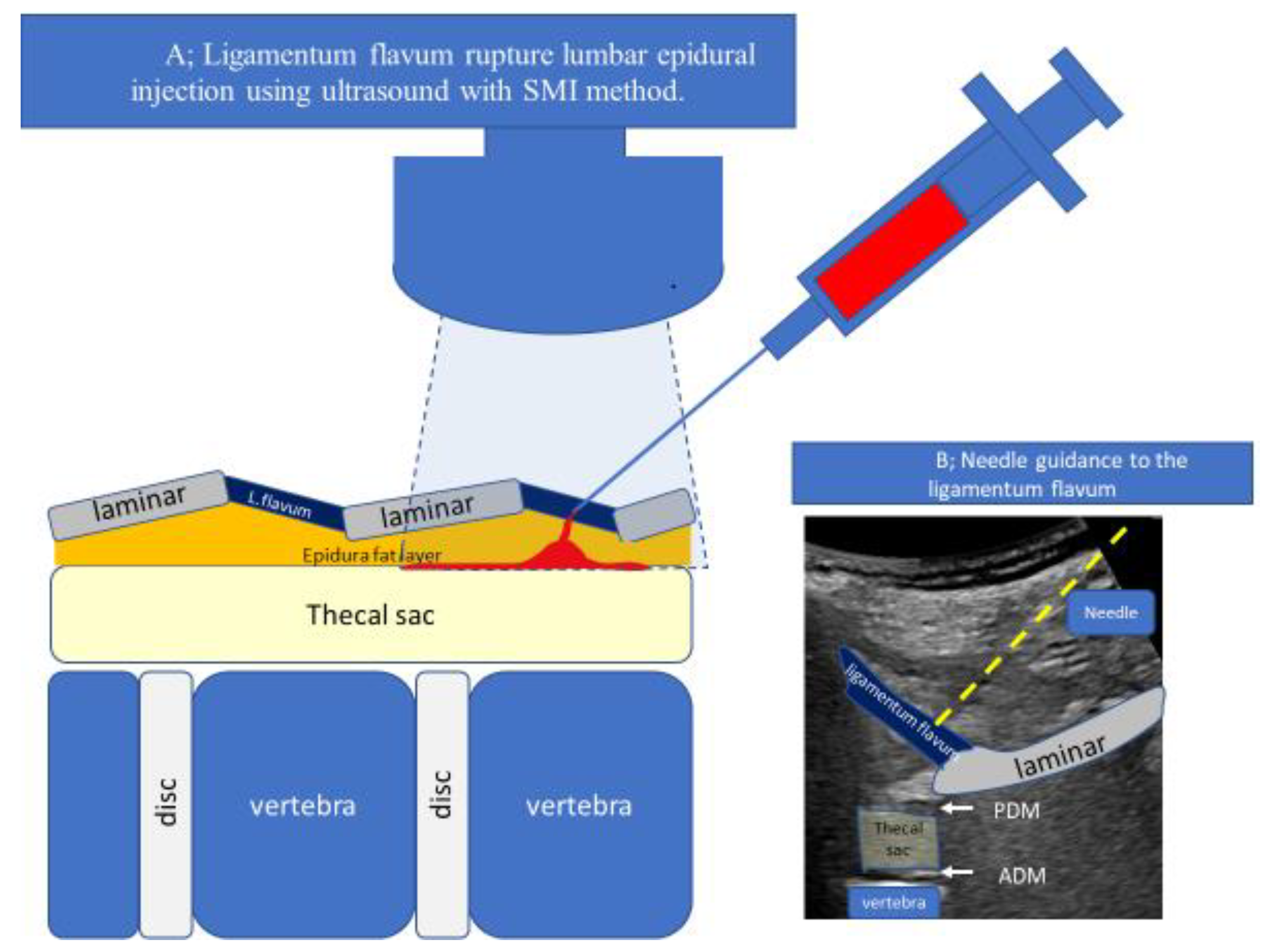 Tomography | Free Full-Text | Ligamentum Flavum Rupture by Epidural  Injection Using Ultrasound with SMI Method