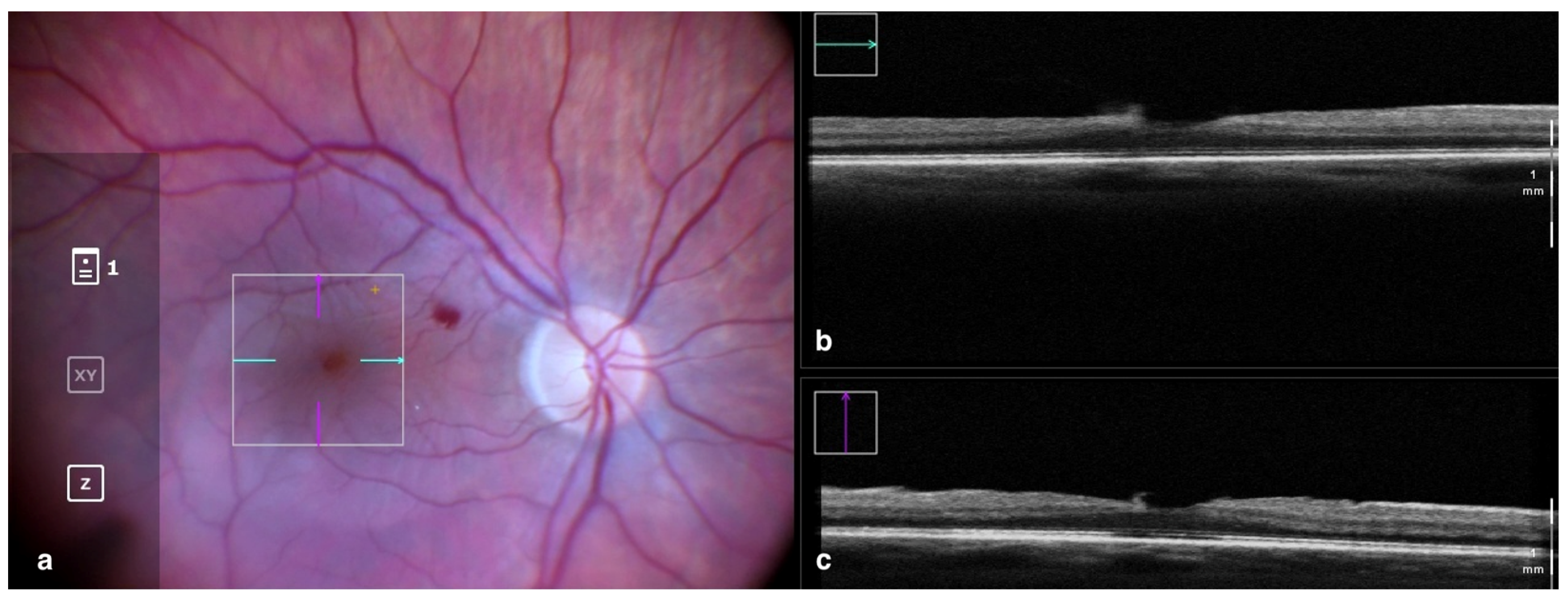 Tomography | Free Full-Text | The State Of Intraoperative OCT In ...