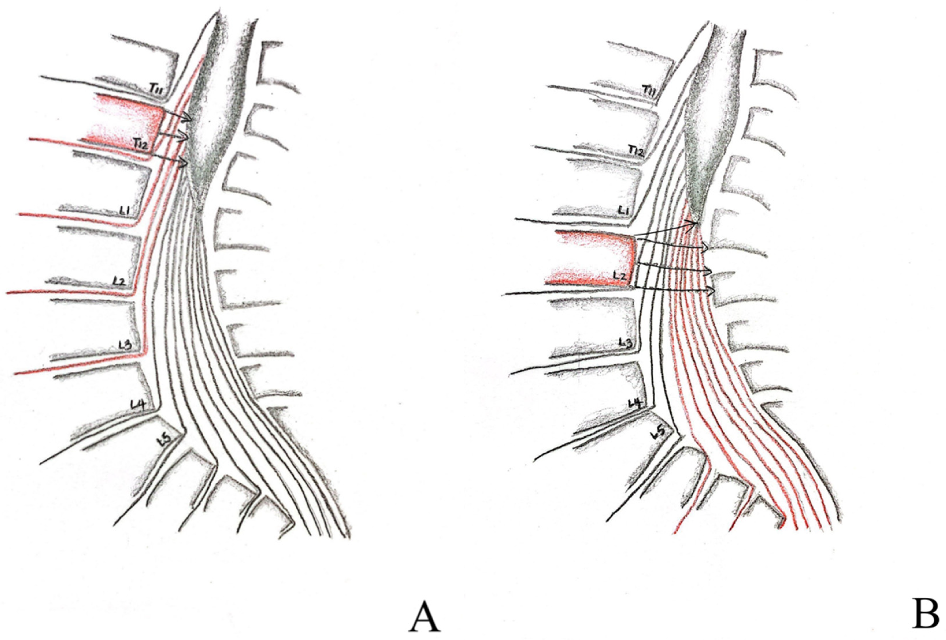 cauda equina vs conus medullaris syndrome