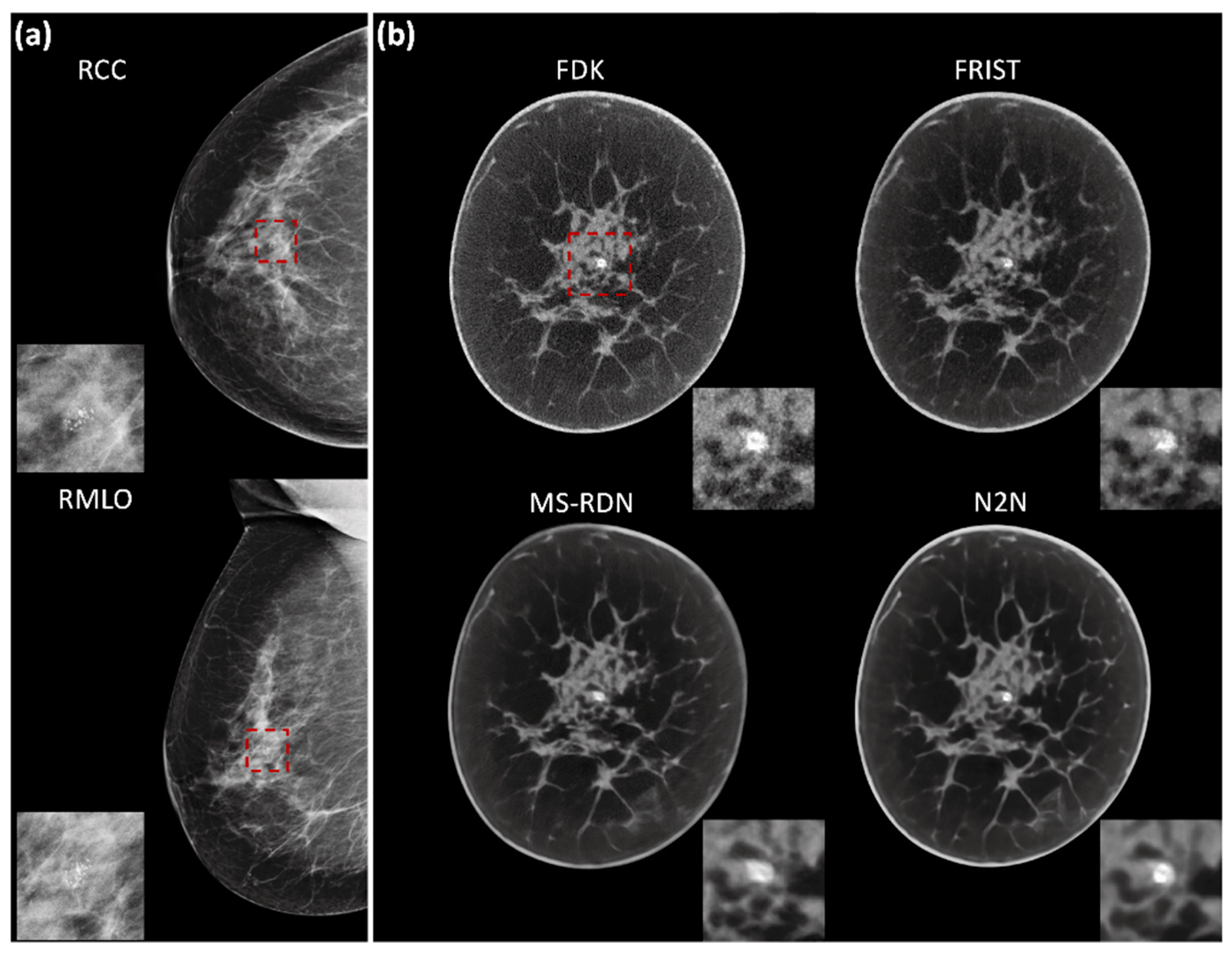 Frontiers  Cone-beam breast CT-guided surface location facilitates breast-conserving  surgery in breast cancer patients with extensive calcifications: A pilot  study