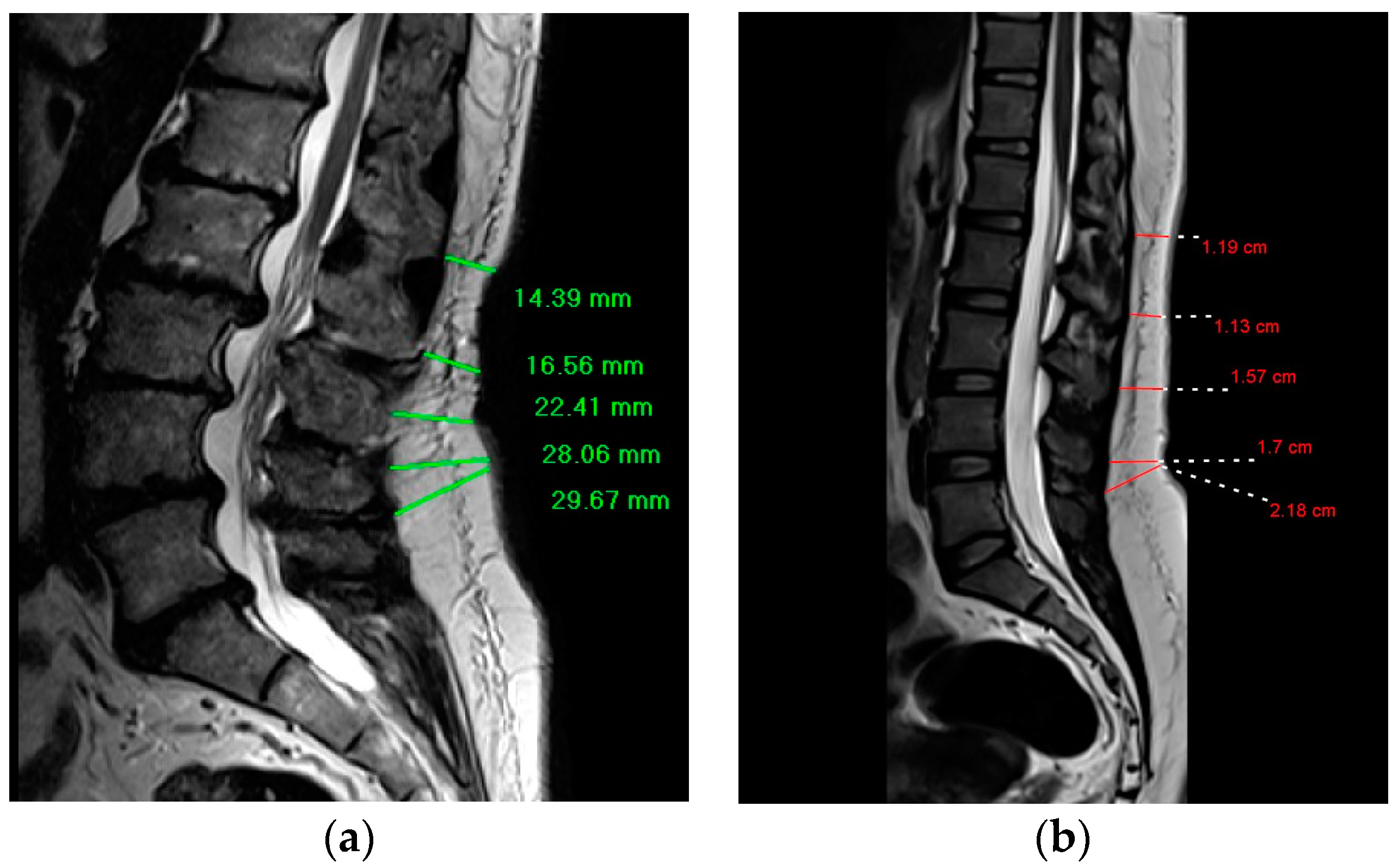 Computed tomography scan of the dorso-lumbar spine showing no