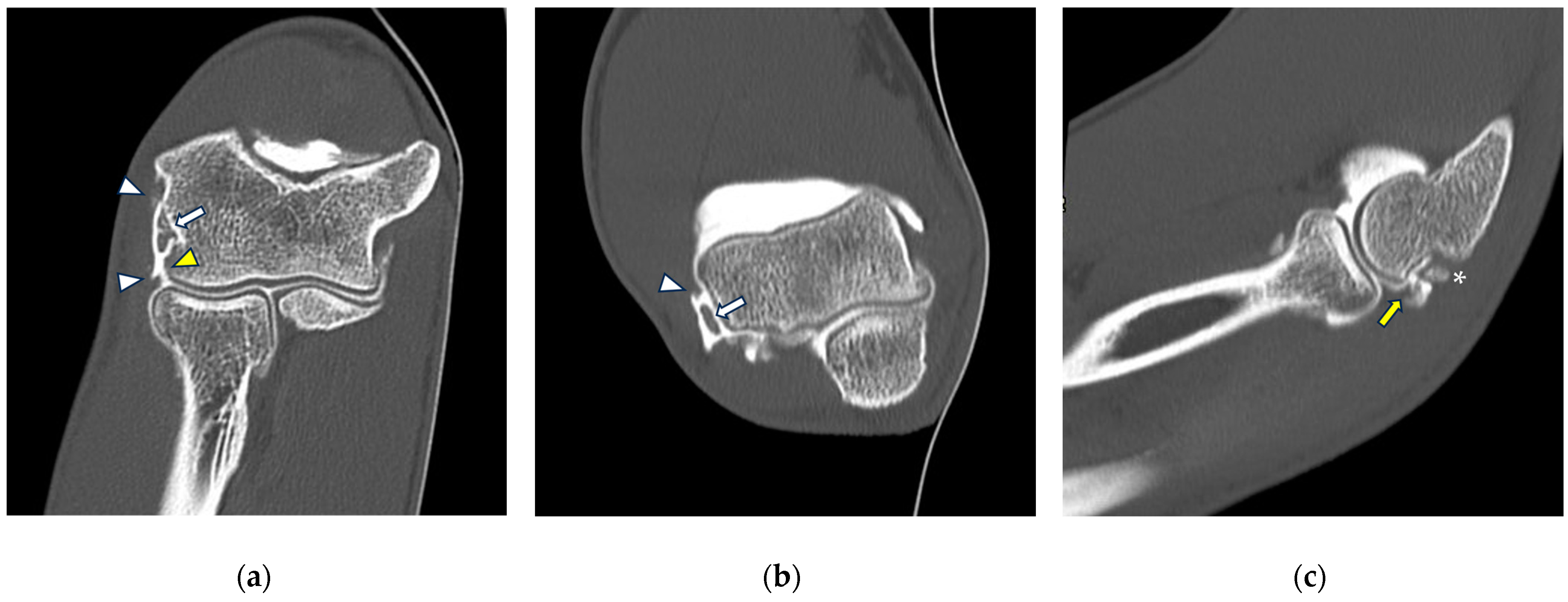 2022新発 肘関節外科の実際 = Surgery of the Elbow : 私のアプロ