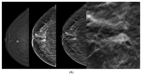 Tomography | Free Full-Text | Digital Breast Tomosynthesis for Upgraded ...