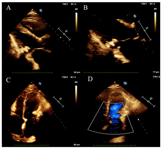 Tomography Free Full Text Pericardial Calcification An Uncommon