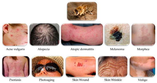 Toxins | Free Full-Text | Potential Therapeutic Applications of Bee Venom  on Skin Disease and Its Mechanisms: A Literature Review