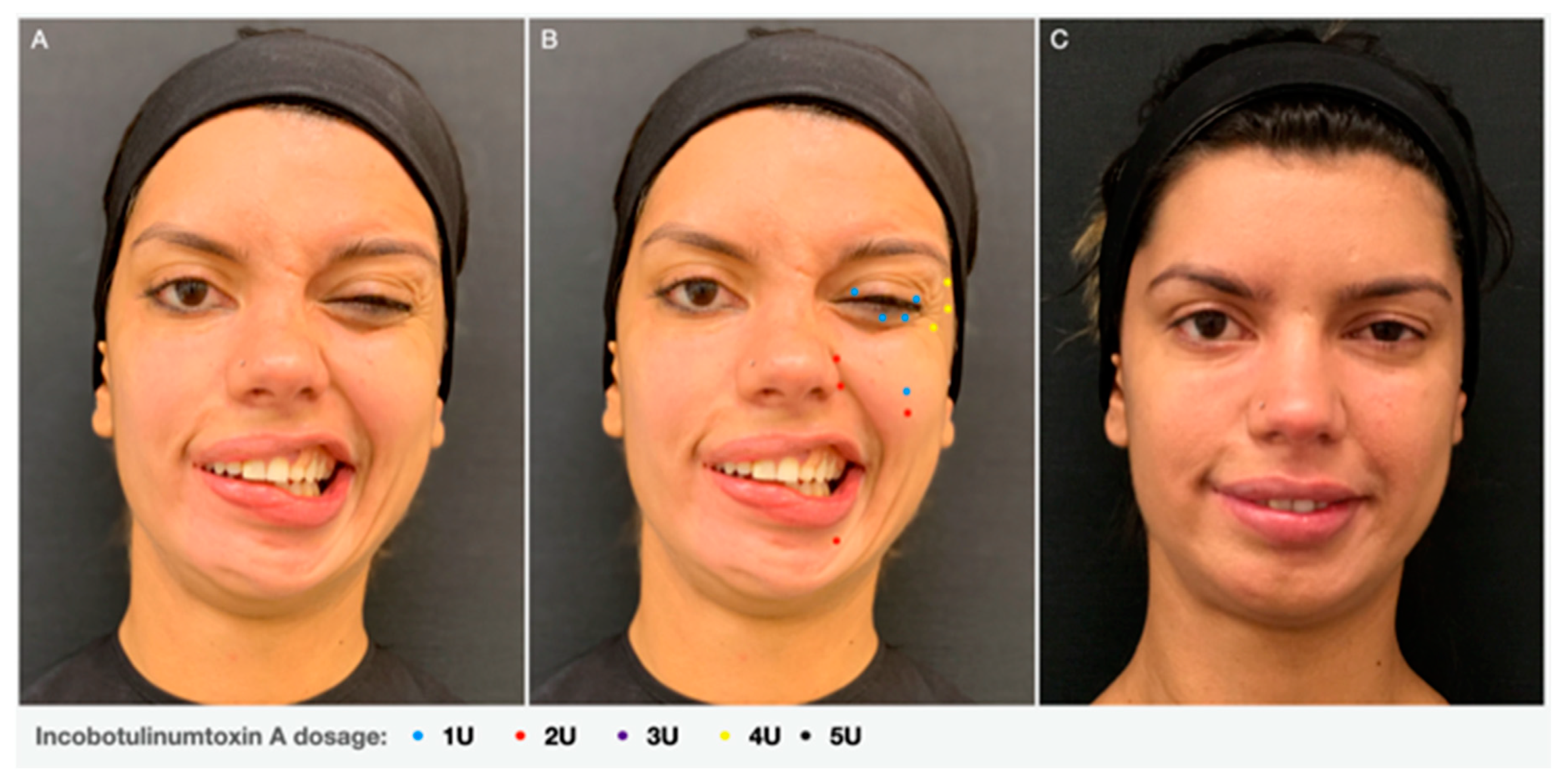 mentalis botox before and after