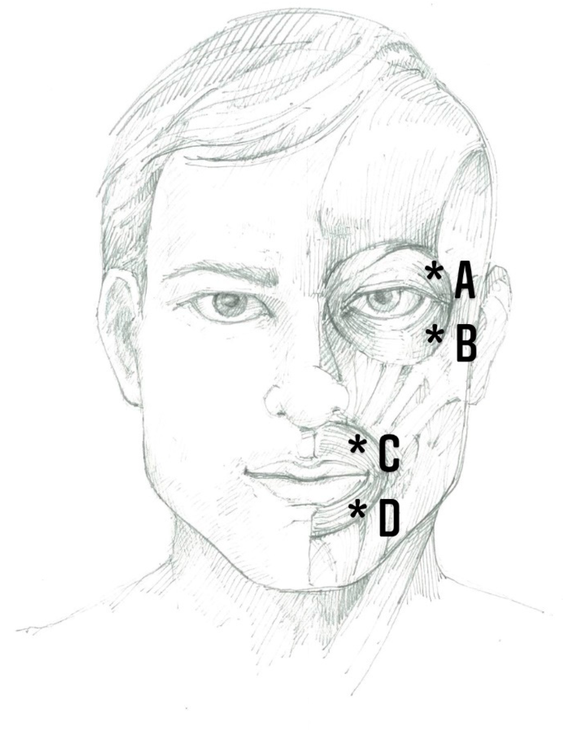 Hemifacial Spasm Treatment Botox Eyelid And Facial Spasms Westchester Eye Surgeons There Was 