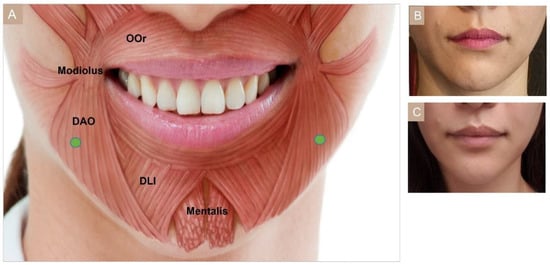 Toxins Free Full Text Cosmetic Treatment Using Botulinum Toxin