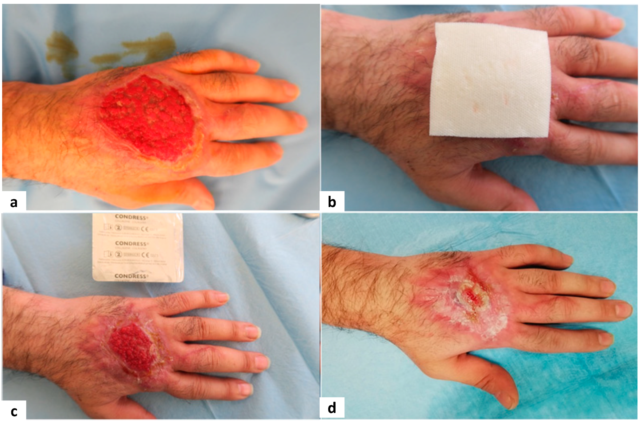 A 47-year-old man with a necrotic wound after trauma  Digital Journal of  Ophthalmology