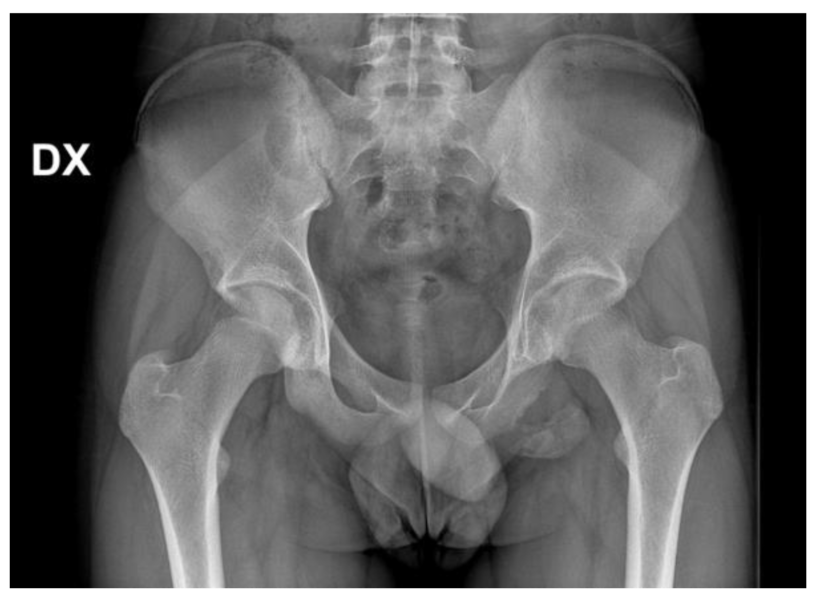 Trauma Care | Free Full-Text | Current Concepts in Pediatric Pelvic Ring  Fractures: A Narrative Review
