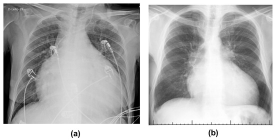 TropicalMed | Free Full-Text | SARS-CoV-2 Infection and CMV Dissemination  in Transplant Recipients as a Treatment for Chagas Cardiomyopathy: A Case  Report | HTML