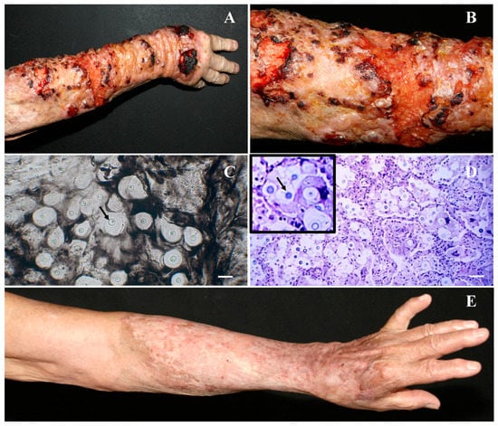 Cureus, Ocular Complications in Patients on Highly Active Antiretroviral  Therapy: A Case Report