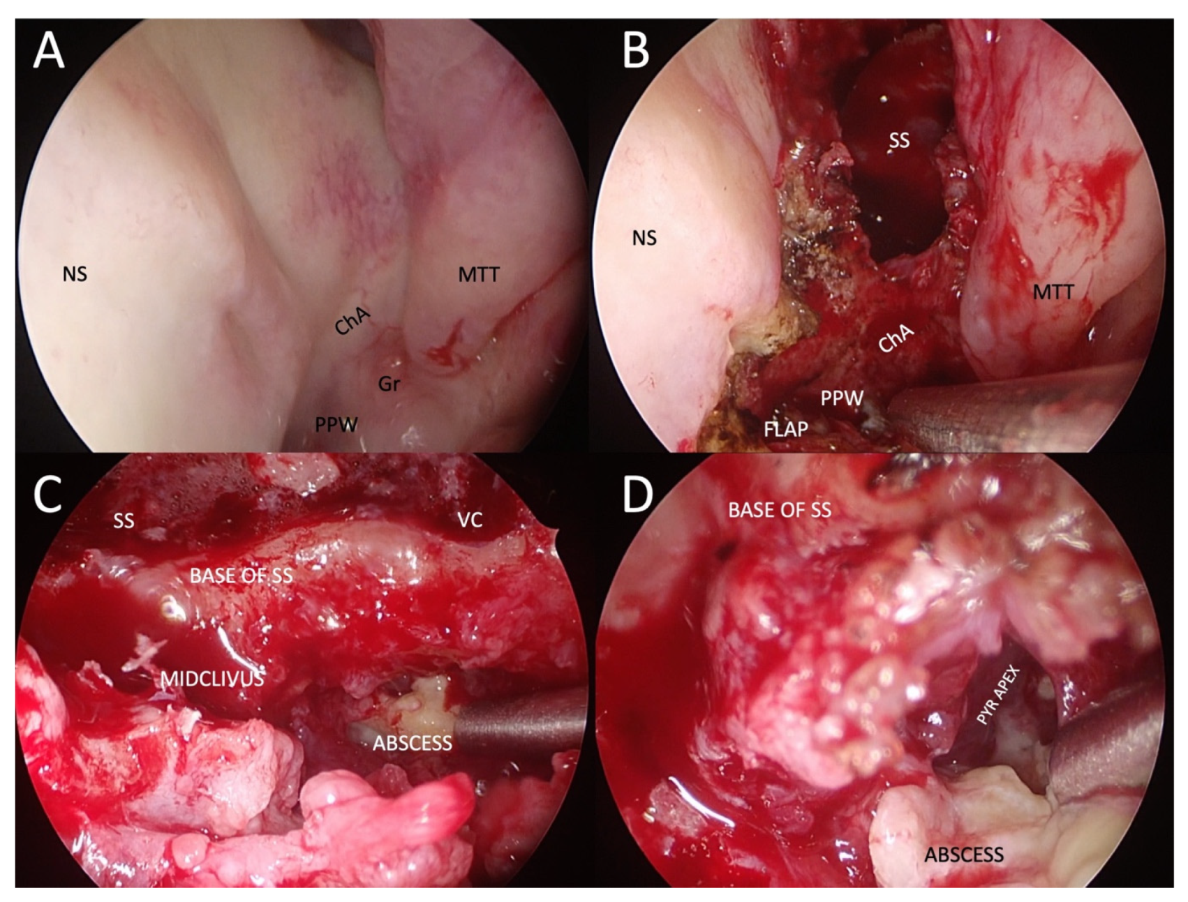 malignant otitis externa granulation tissue