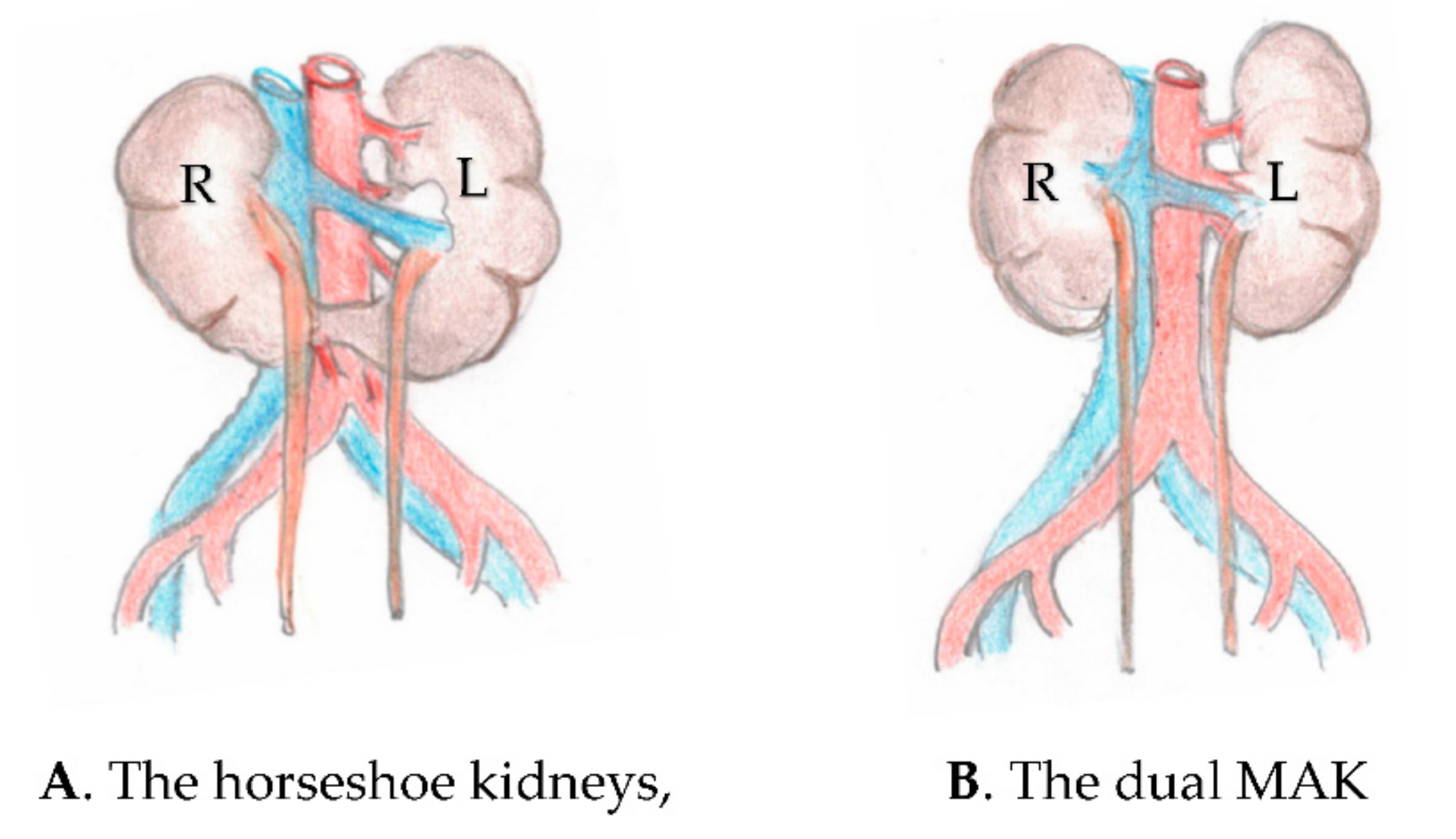 kidney transplant diagram