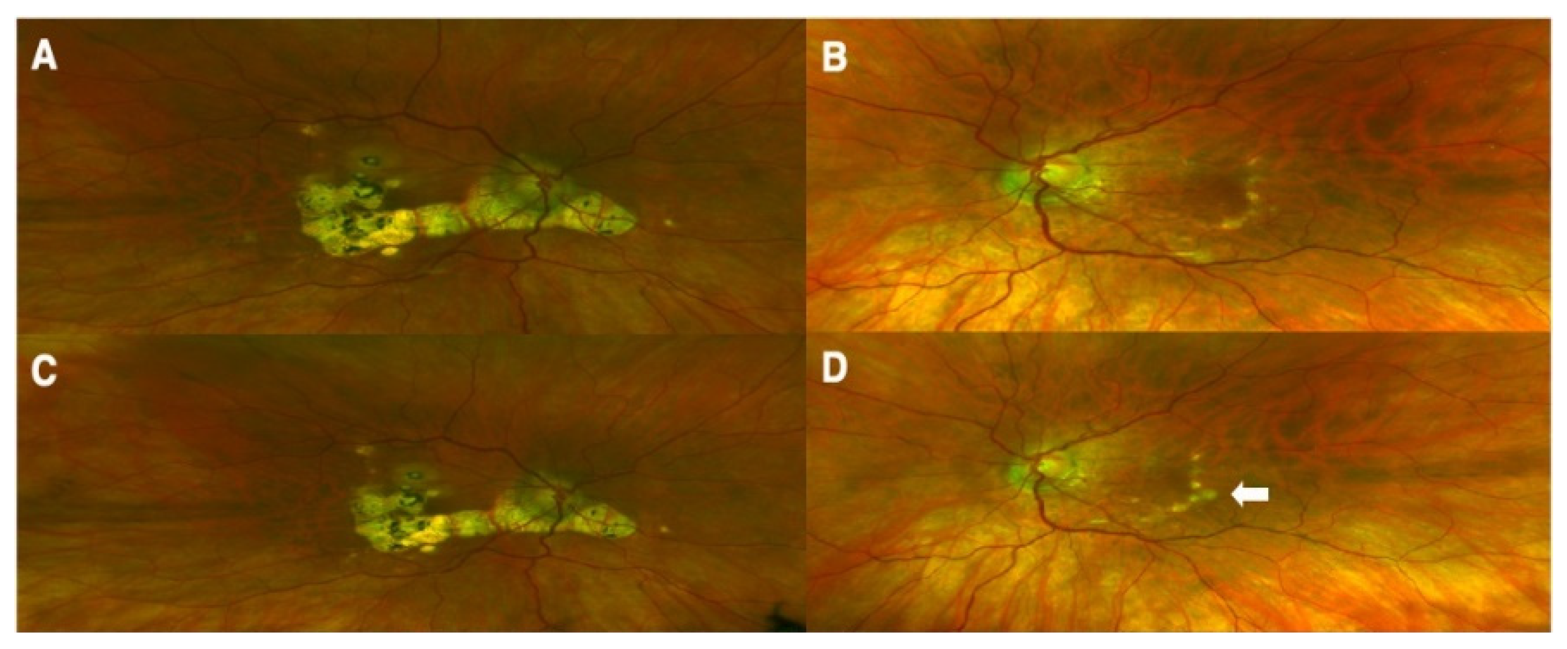 Vaccines | Free Full-Text | Ocular Inflammation Post-Vaccination