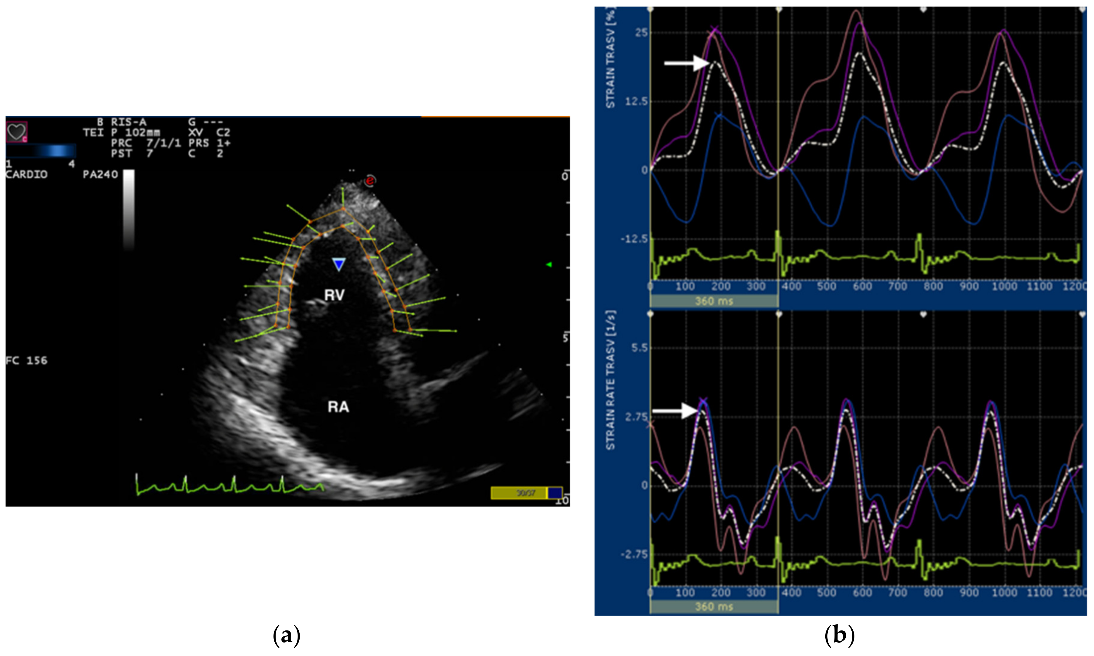 Frontiers  Myocardial strain analysis of echocardiography based