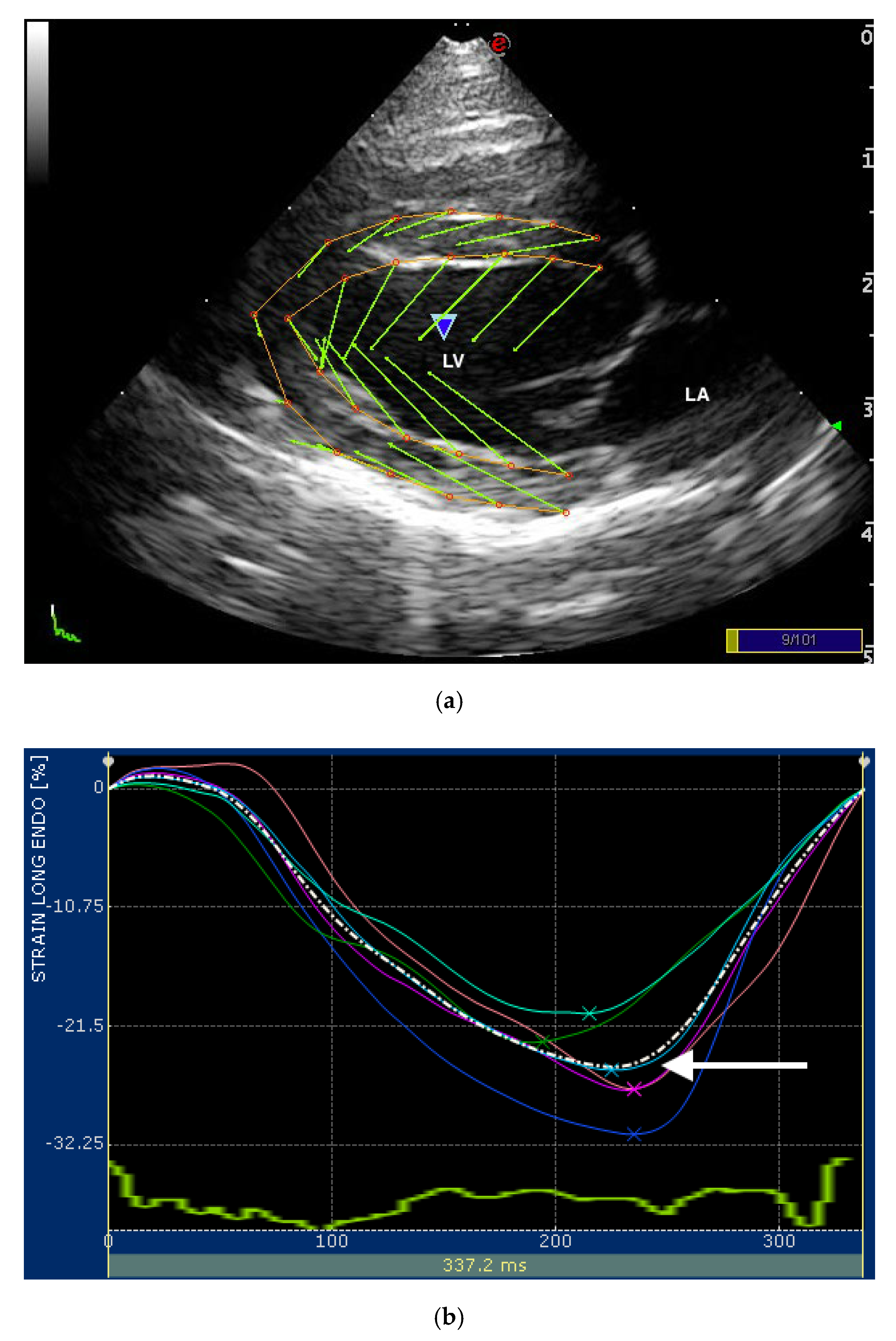Second trimester ultrasound: reference values for two-dimensional speckle  tracking-derived longitudinal strain, strain rate and time to peak  deformation of the fetal heart.