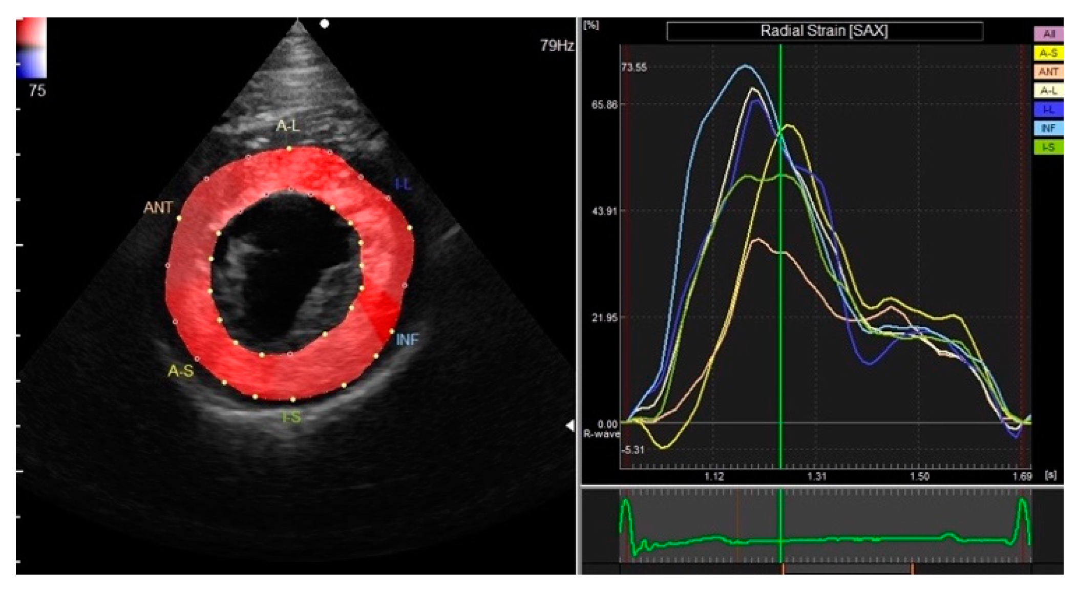 Frontiers  Myocardial strain analysis of echocardiography based